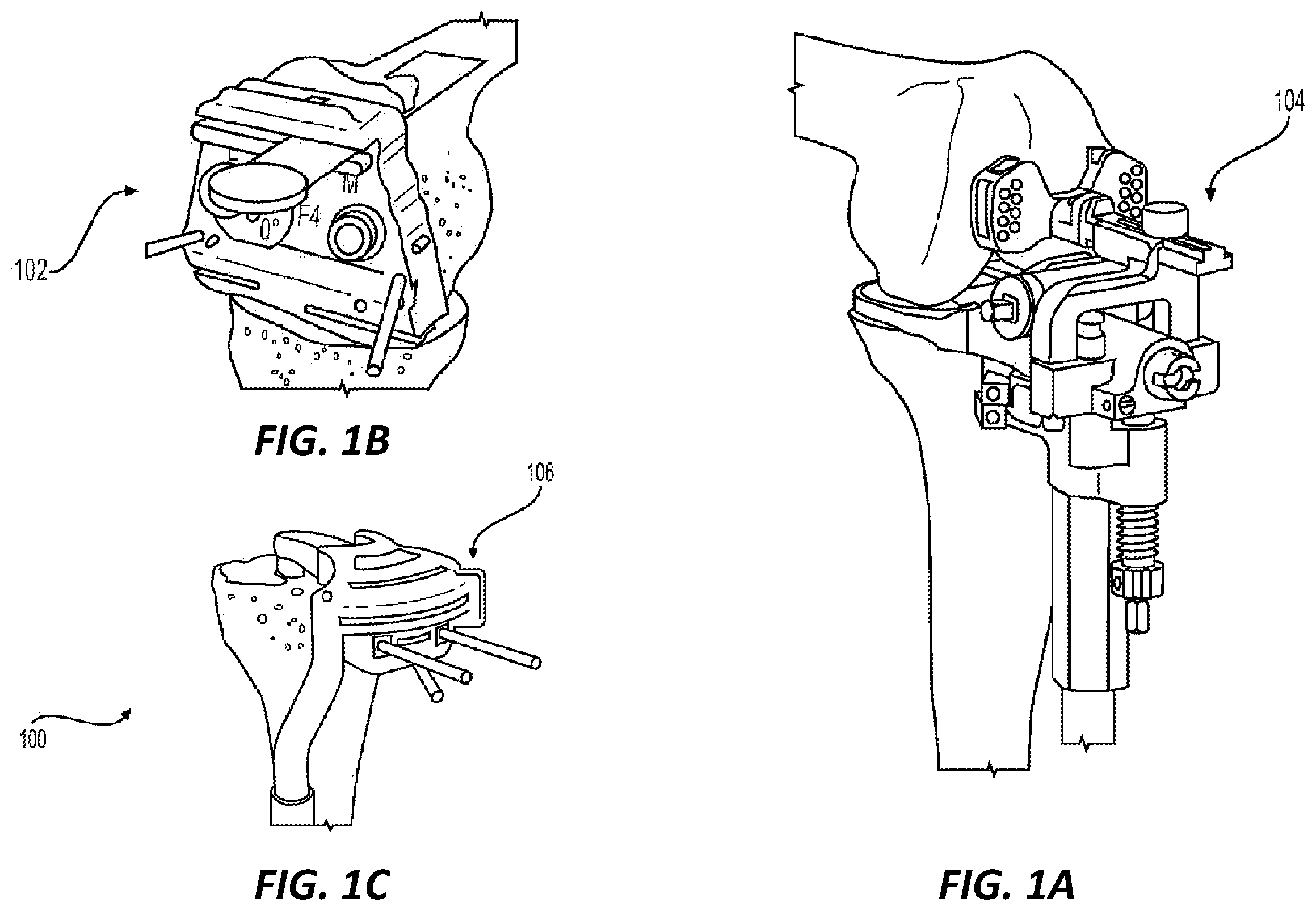 Patent US11812978 Figure 1 – Knee balancing system using patient specific instruments