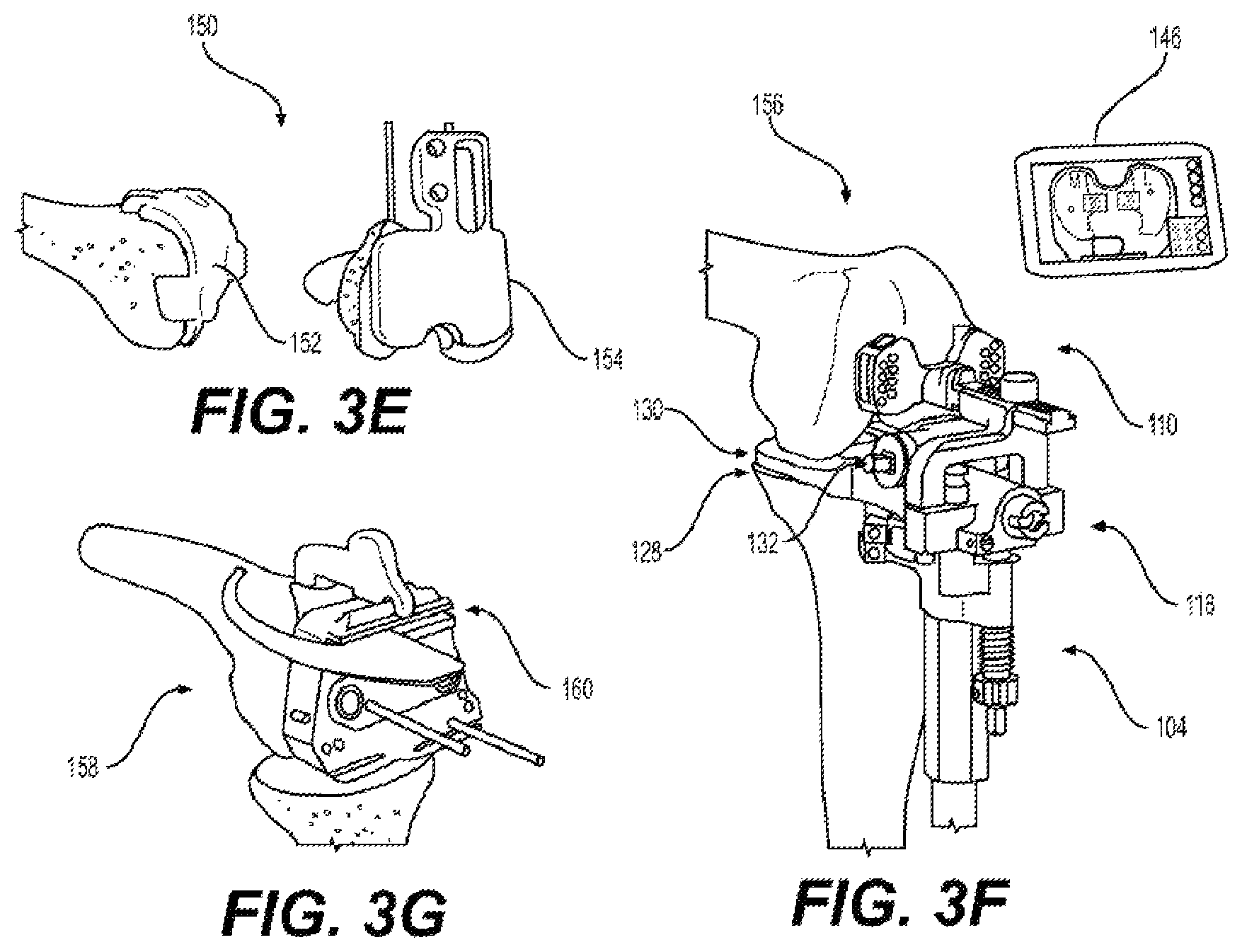 Patent US11812978 Figure 4 – Knee balancing system using patient specific instruments