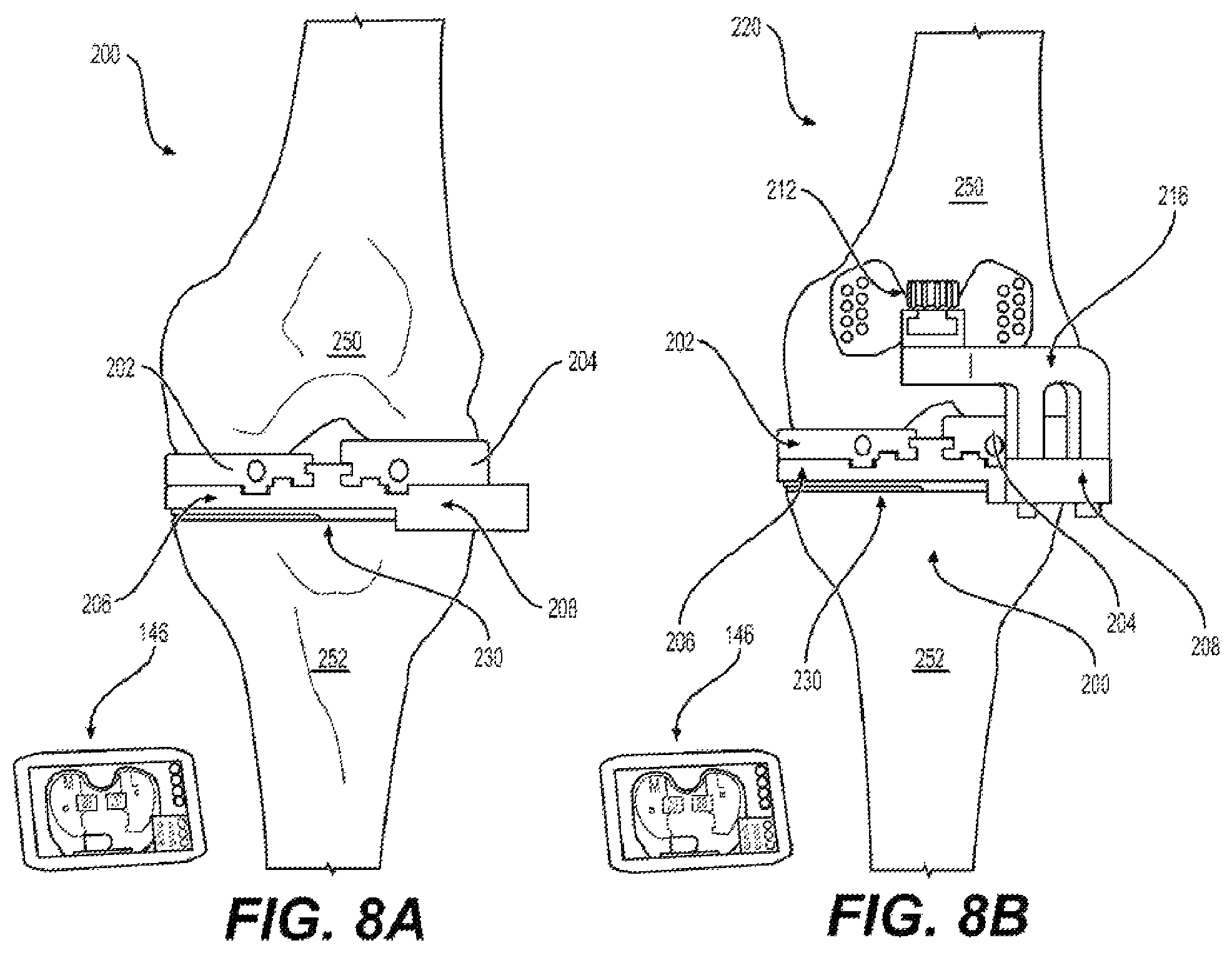 Patent US11812978 Figure 10 – Knee balancing system using patient specific instruments