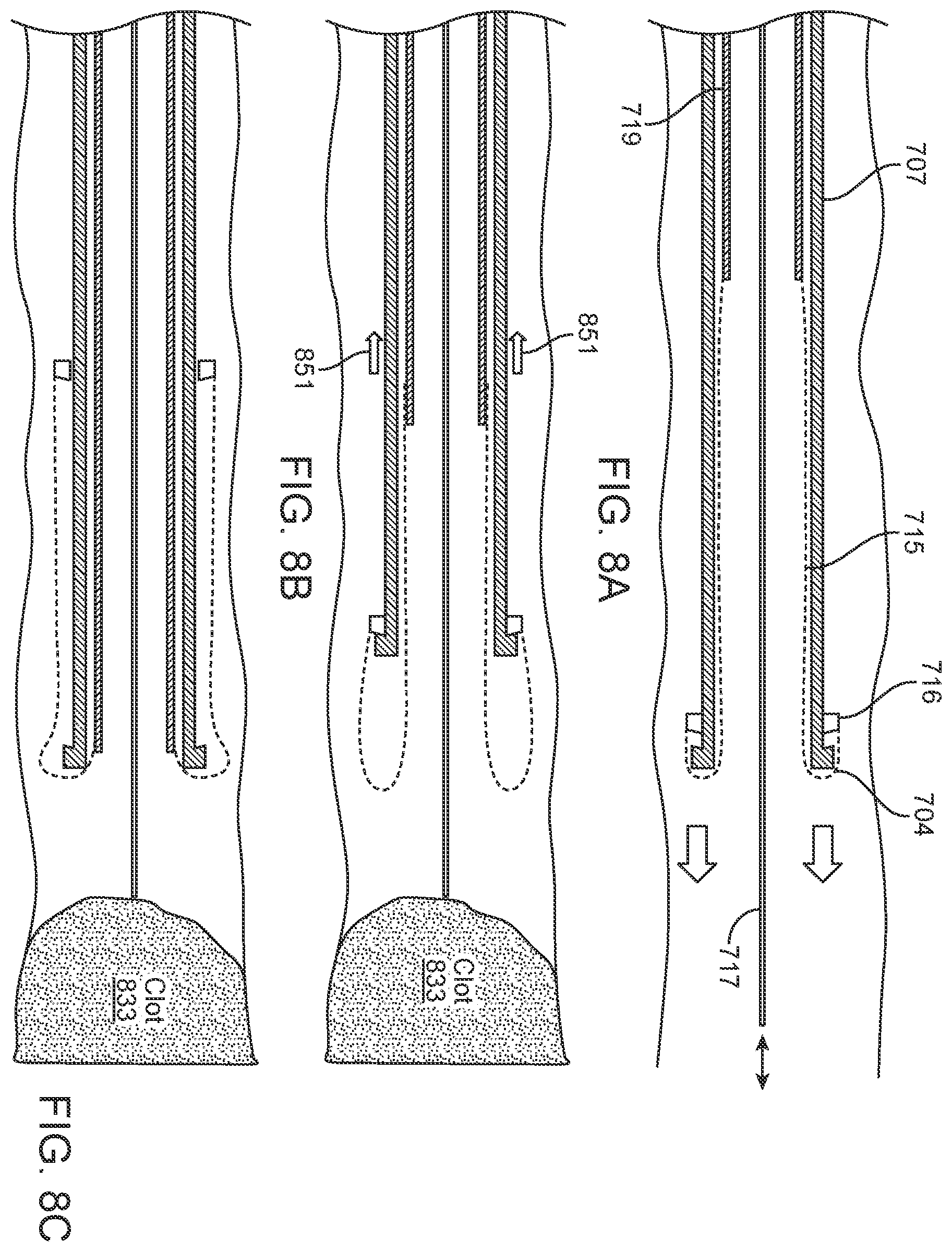 Patent US11812980 Figure 10 – Inverting thrombectomy apparatuses having enhanced tracking