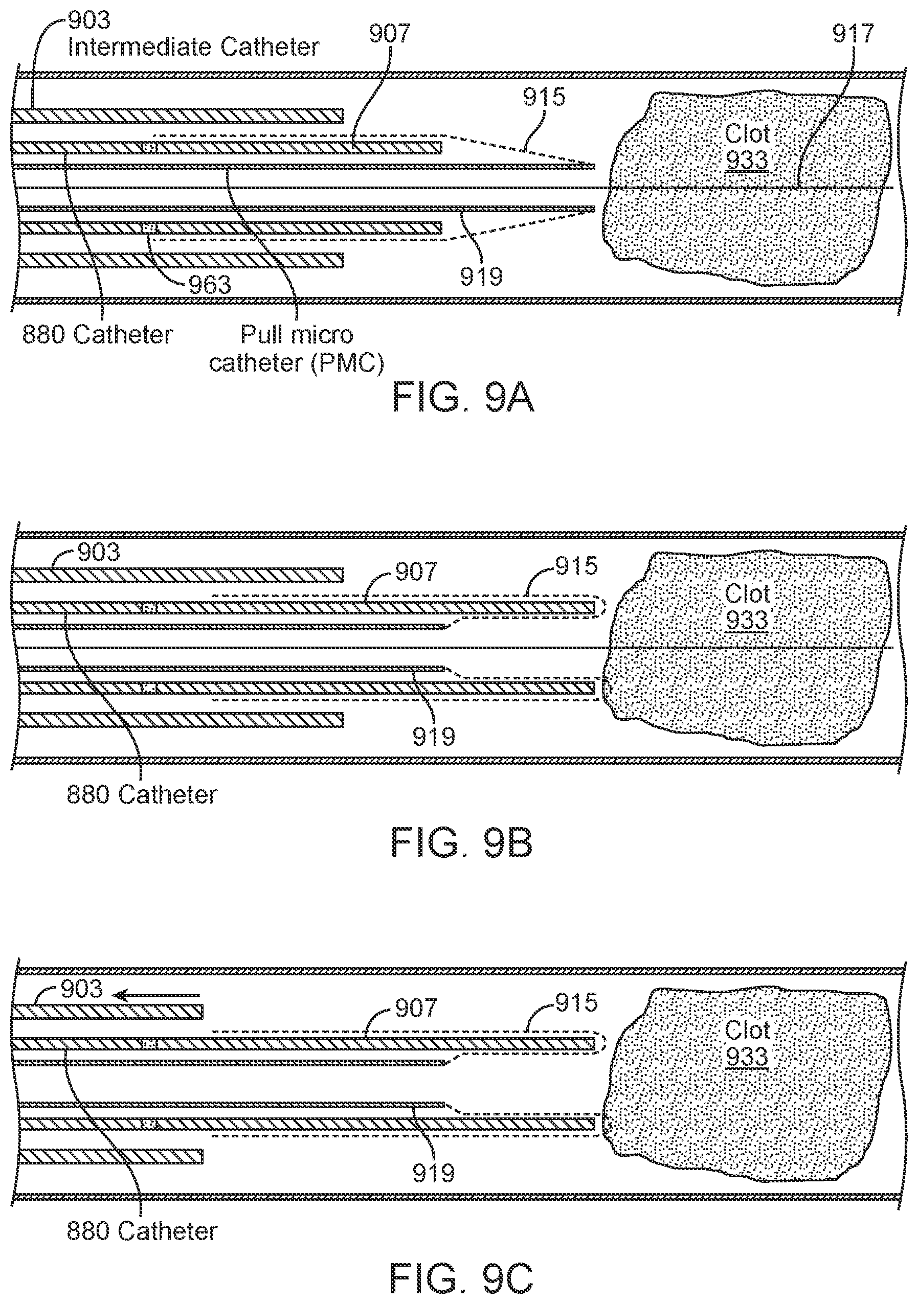 Patent US11812980 Figure 11 – Inverting thrombectomy apparatuses having enhanced tracking