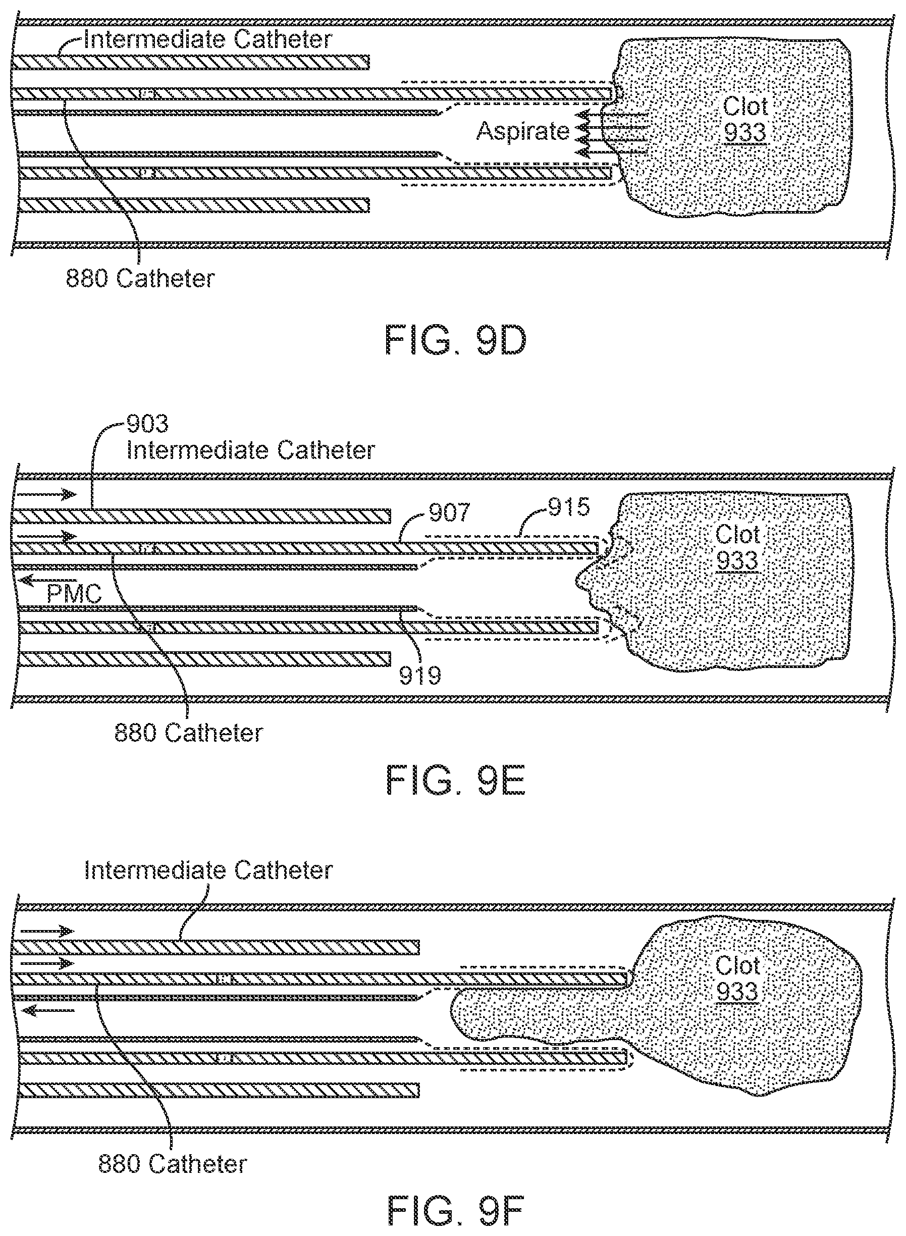 Patent US11812980 Figure 12 – Inverting thrombectomy apparatuses having enhanced tracking