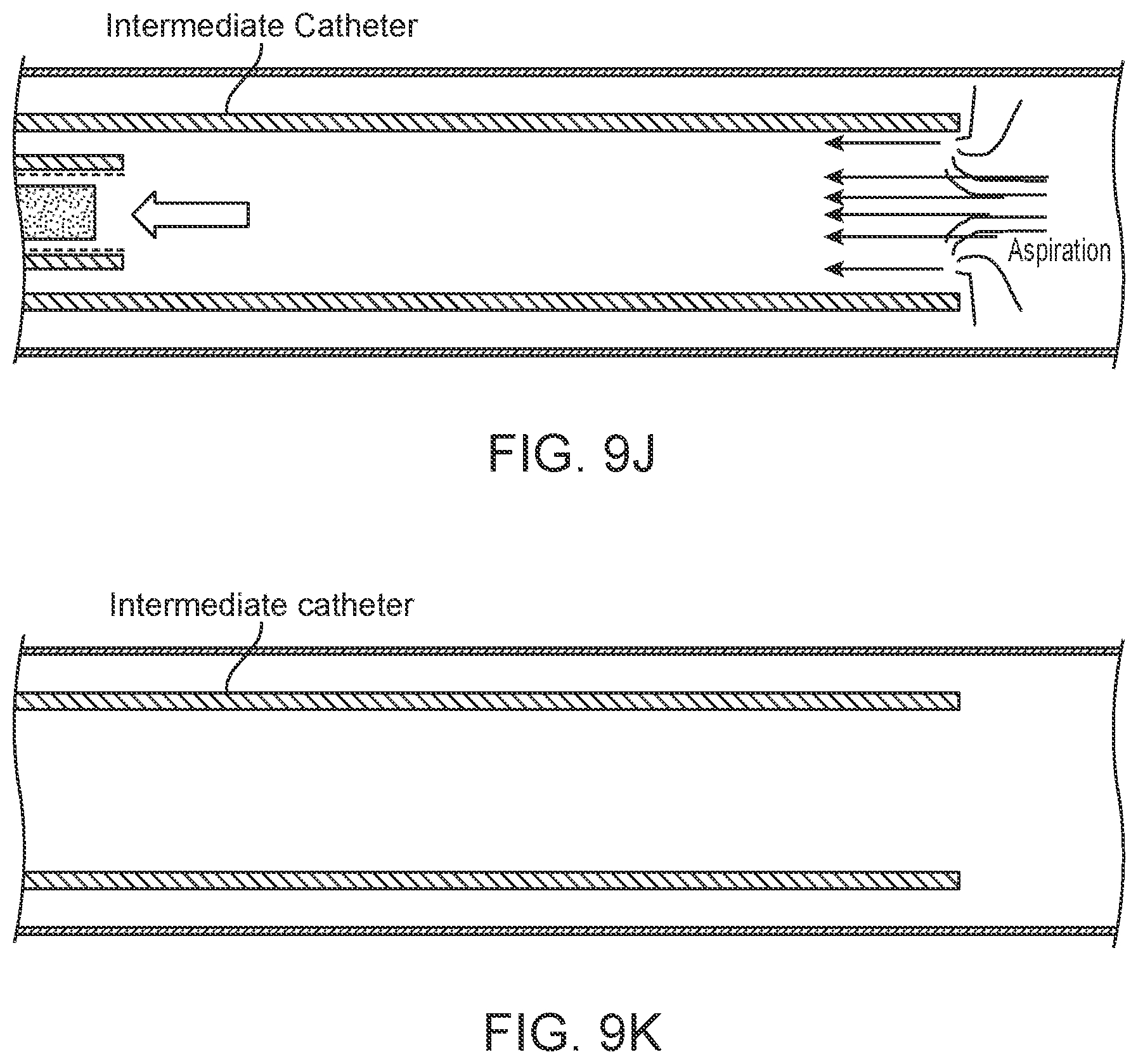 Patent US11812980 Figure 14 – Inverting thrombectomy apparatuses having enhanced tracking