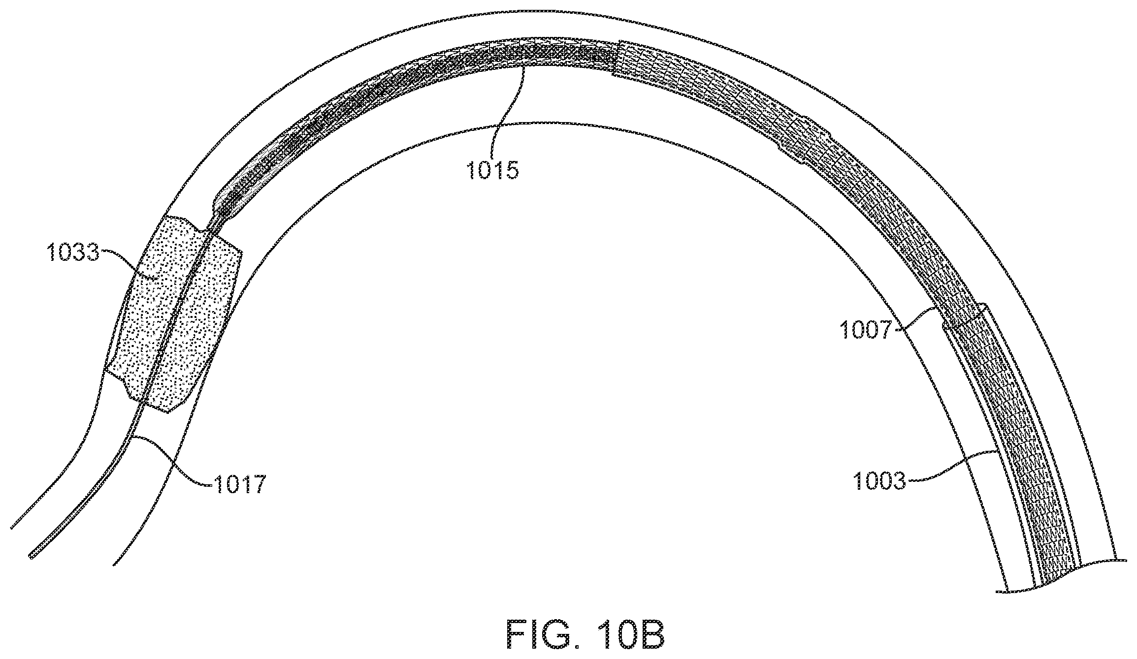 Patent US11812980 Figure 16 – Inverting thrombectomy apparatuses having enhanced tracking