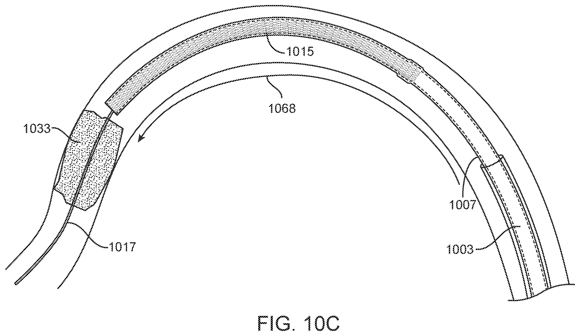Patent US11812980 Figure 17 – Inverting thrombectomy apparatuses having enhanced tracking