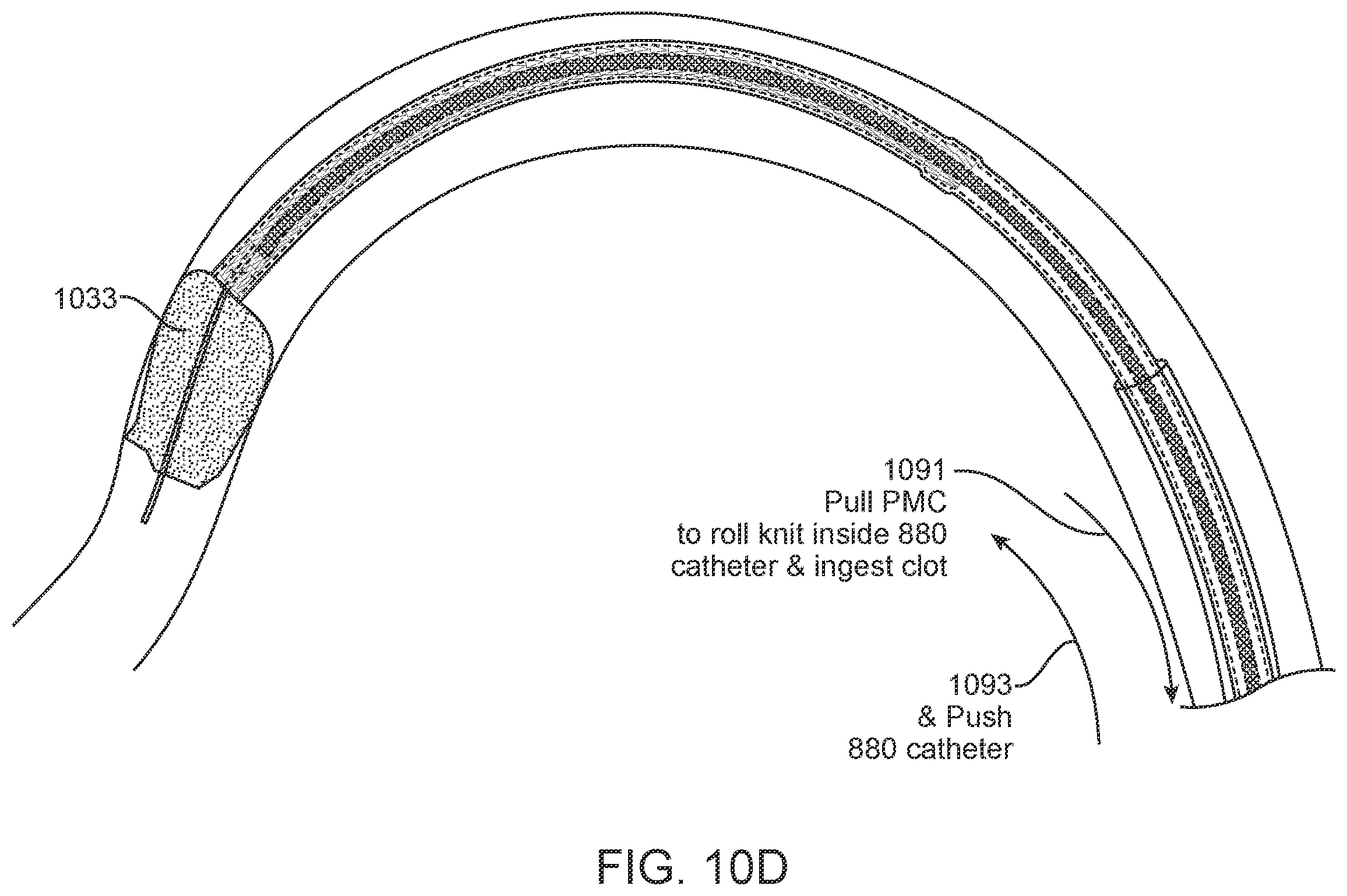 Patent US11812980 Figure 18 – Inverting thrombectomy apparatuses having enhanced tracking