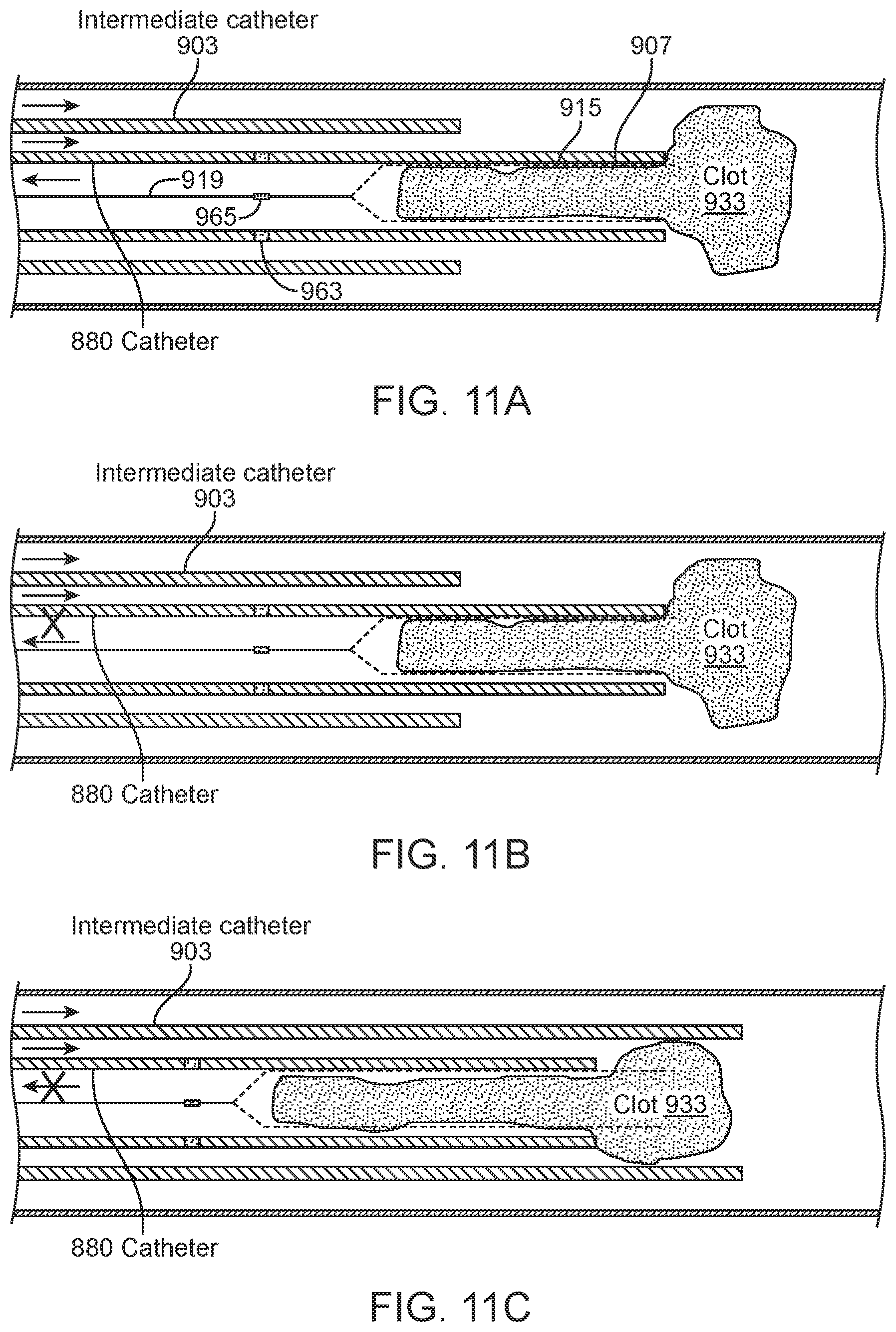 Patent US11812980 Figure 19 – Inverting thrombectomy apparatuses having enhanced tracking