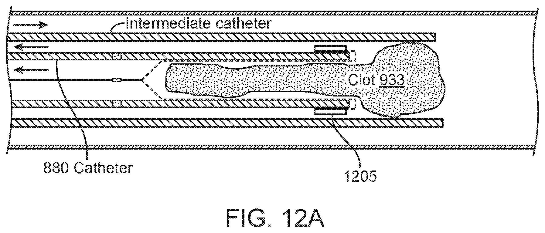 Patent US11812980 Figure 20 – Inverting thrombectomy apparatuses having enhanced tracking