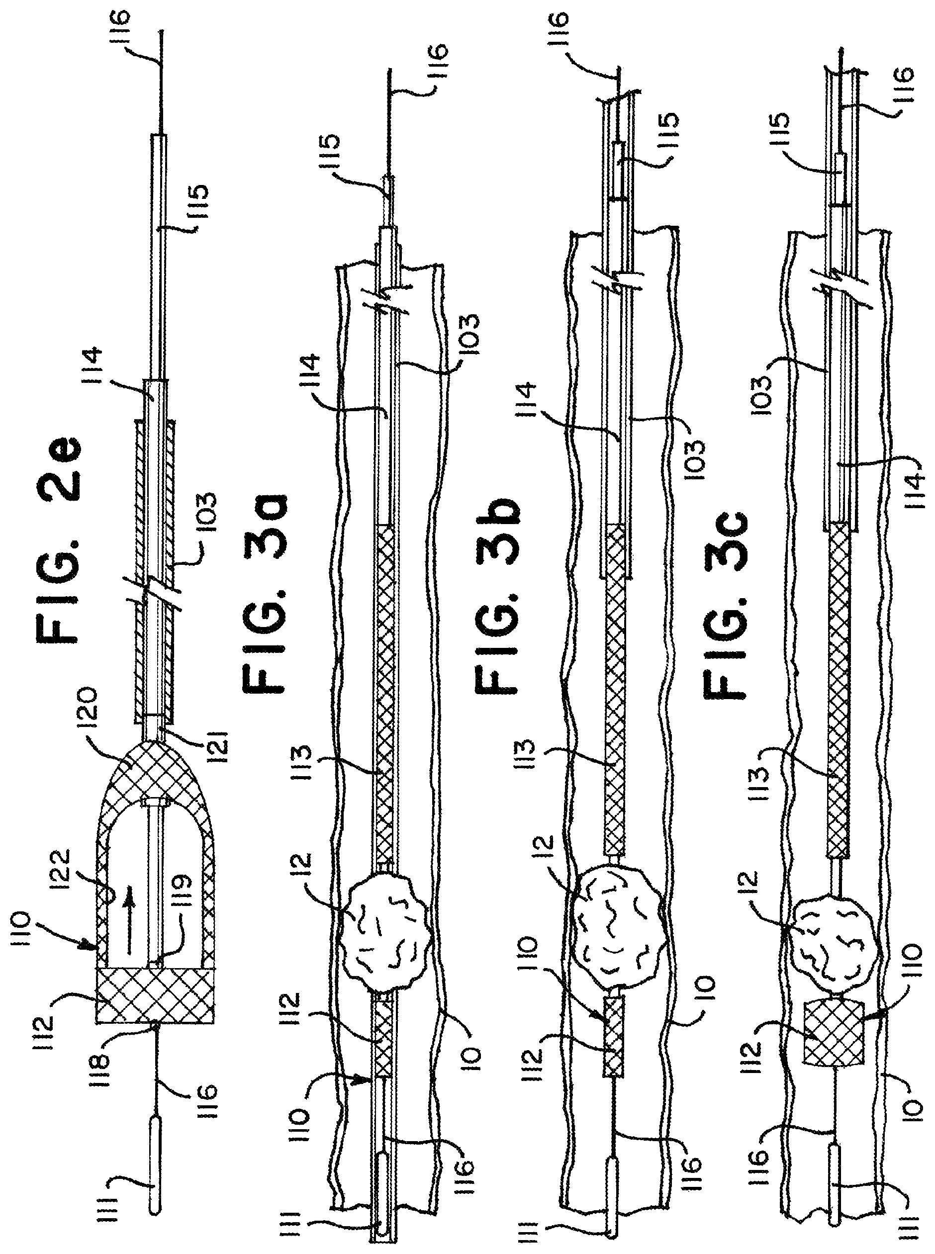 Patent US11812981 Figure 3 – Vasculature obstruction capture device
