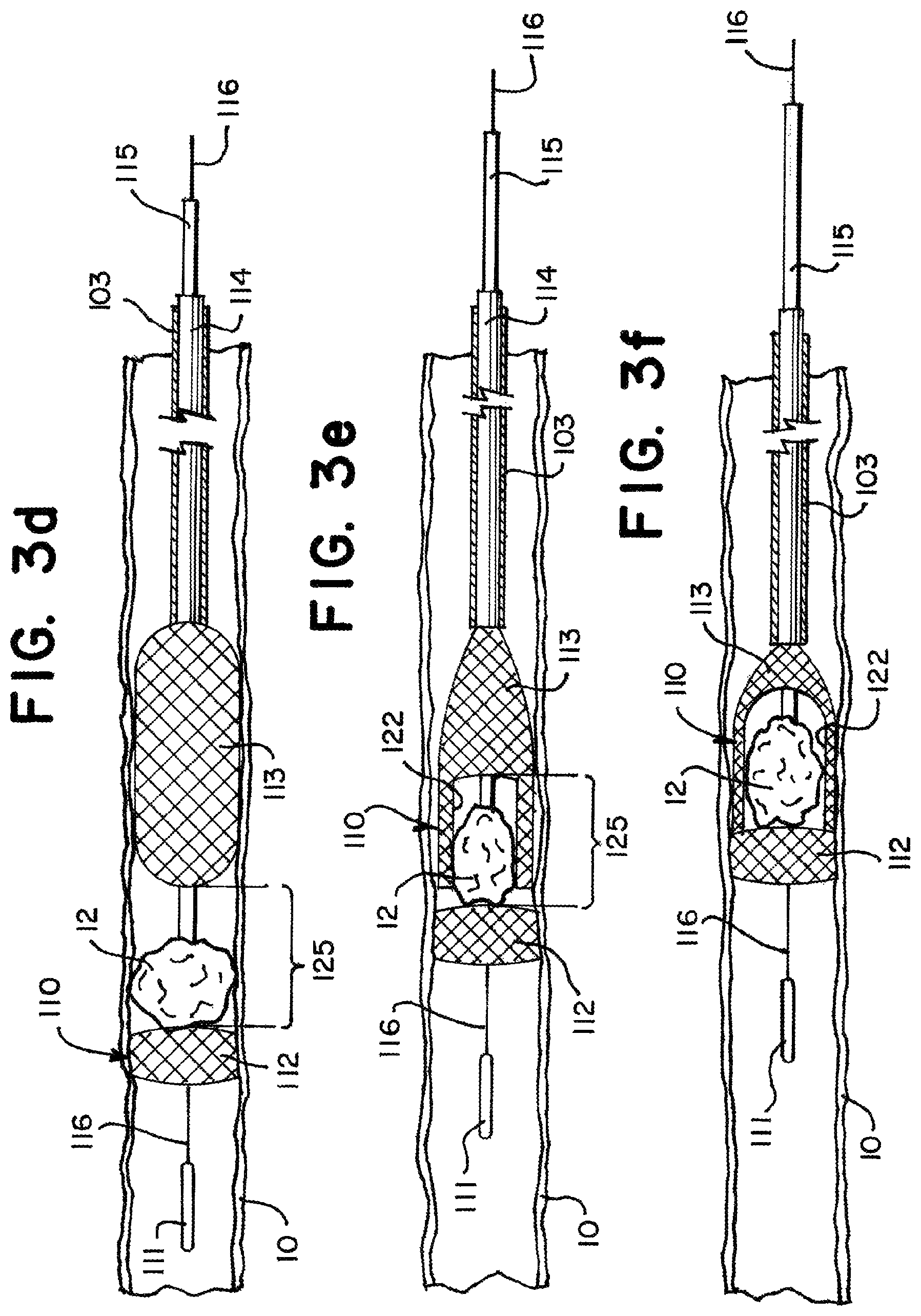 Patent US11812981 Figure 4 – Vasculature obstruction capture device