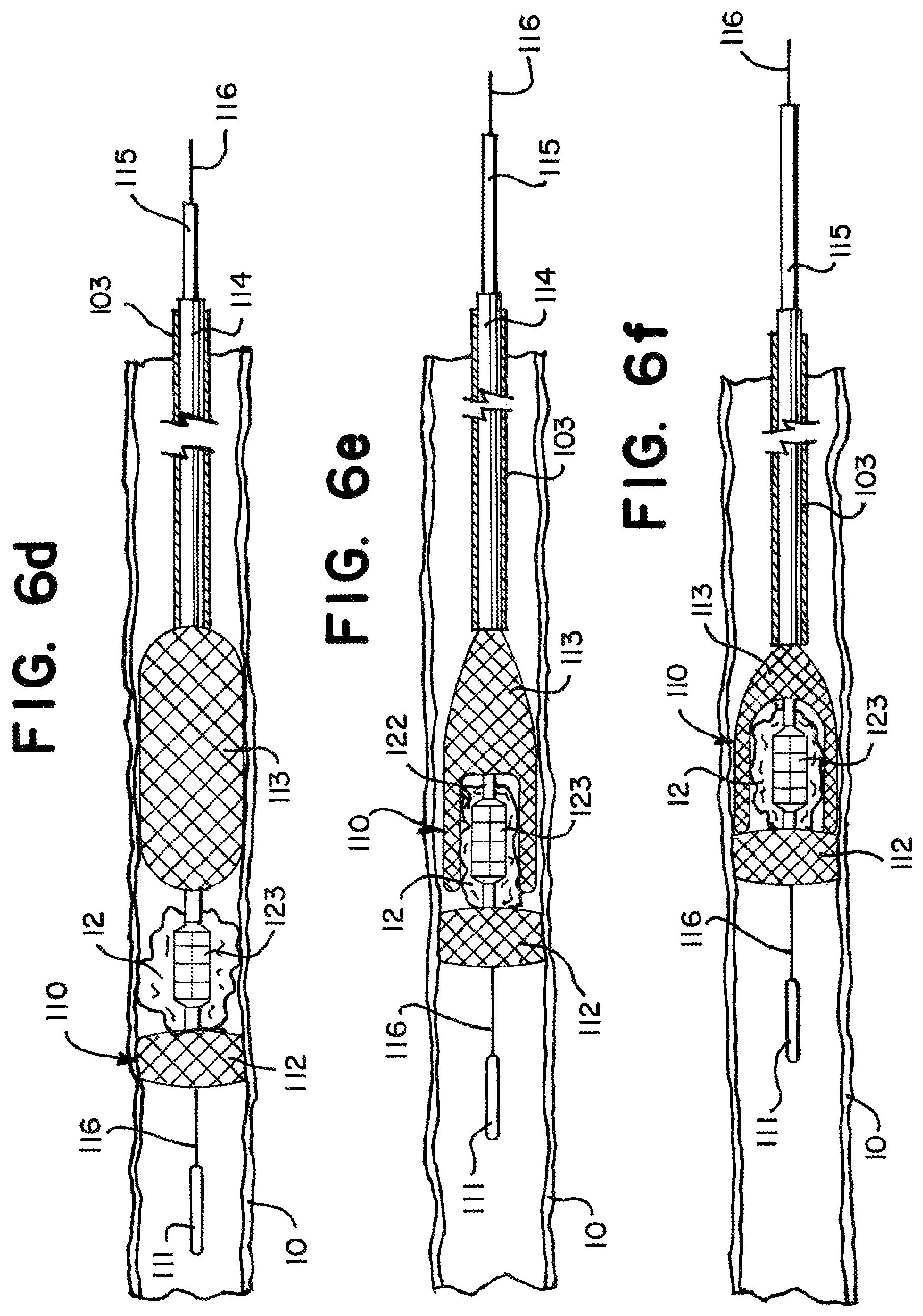 Patent US11812981 Figure 8 – Vasculature obstruction capture device