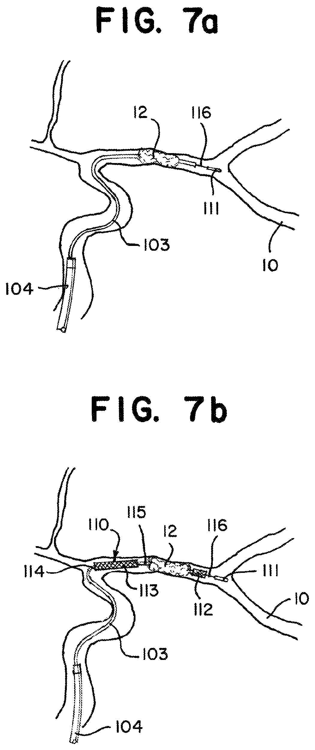 Patent US11812981 Figure 9 – Vasculature obstruction capture device