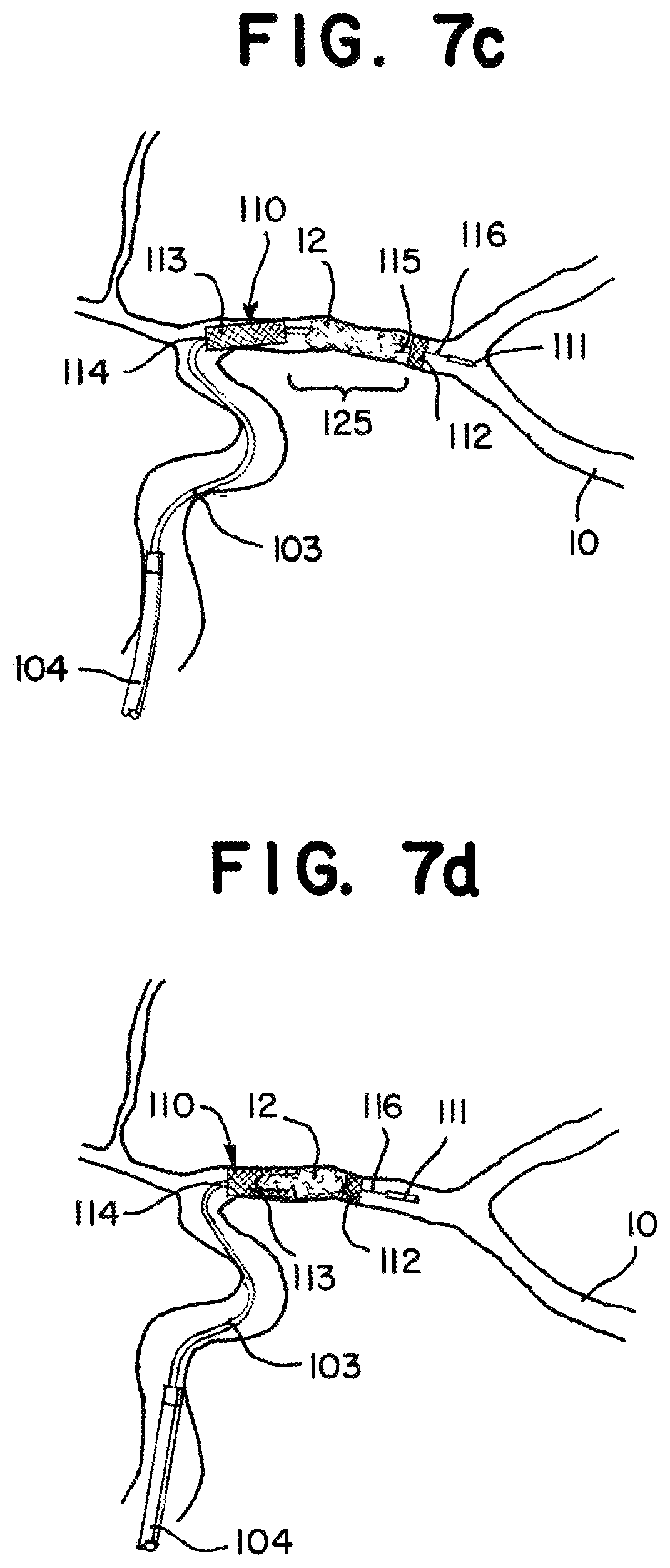 Patent US11812981 Figure 10 – Vasculature obstruction capture device