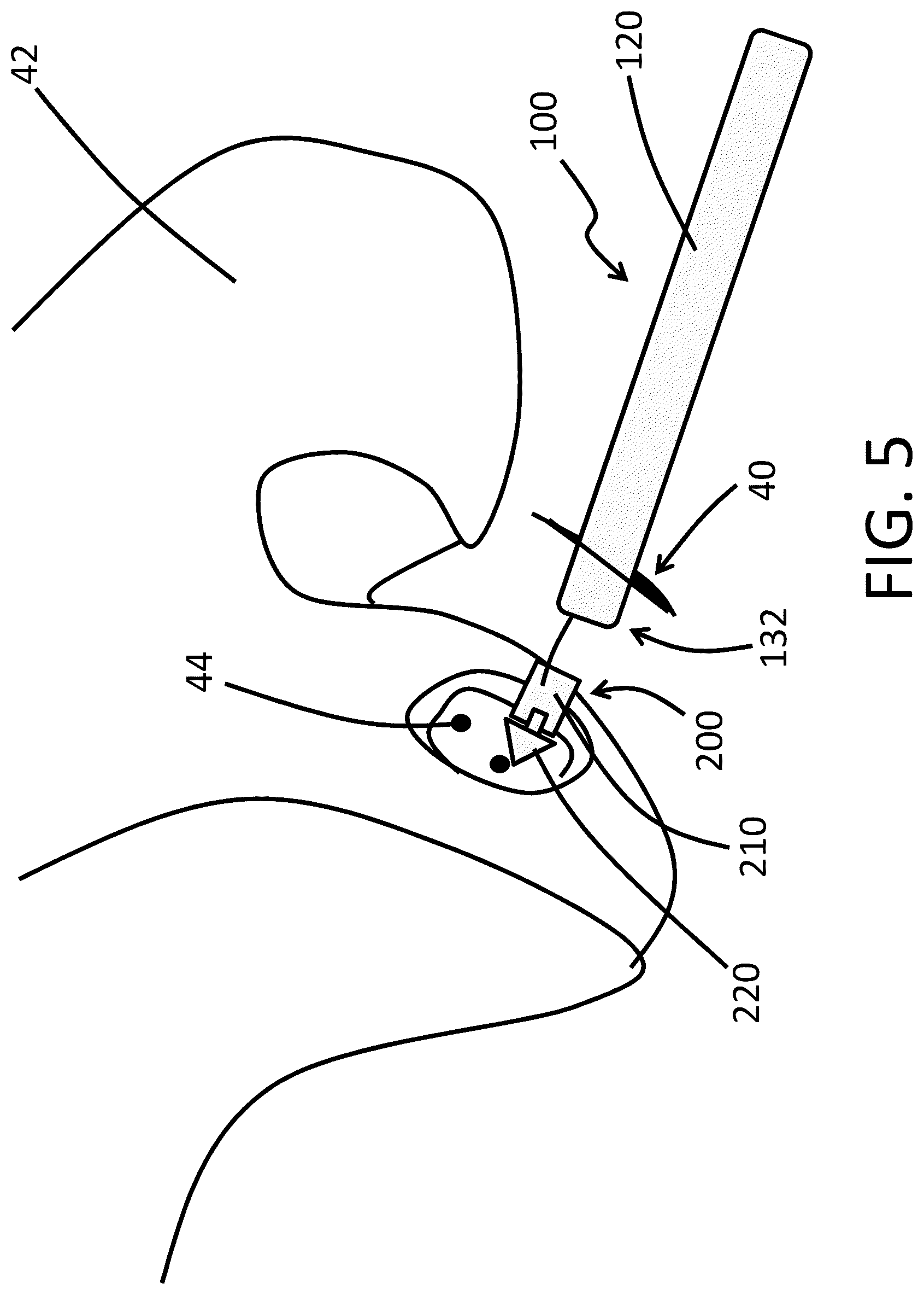 Patent US11812985 Figure 5 – Endoscopy systems and methods of use thereof