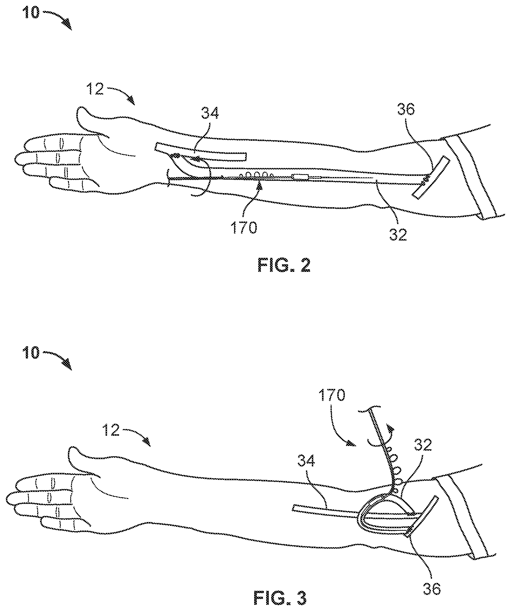 Patent US11812988 Figure 2 – Atherectomy devices and methods