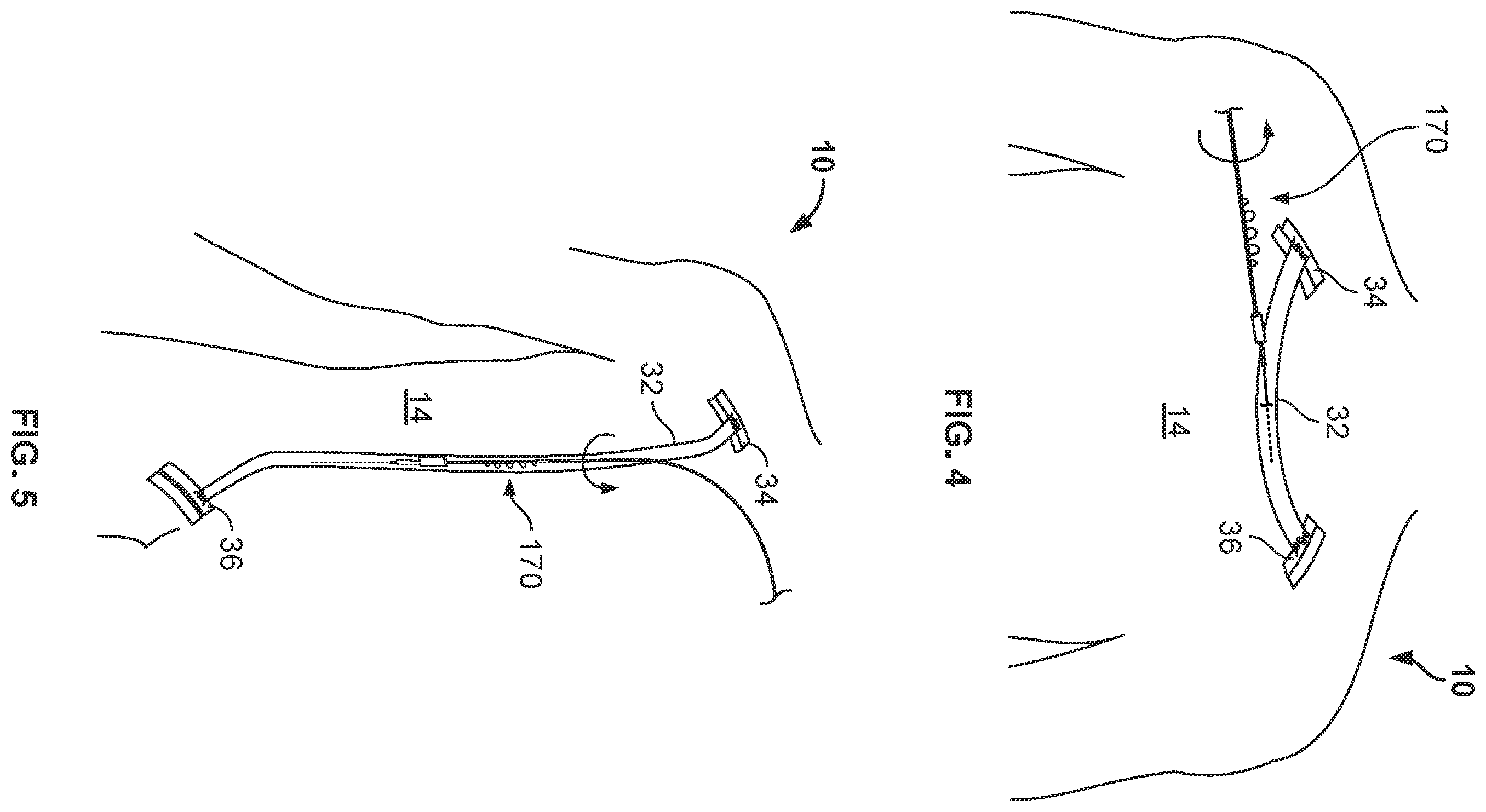 Patent US11812988 Figure 3 – Atherectomy devices and methods