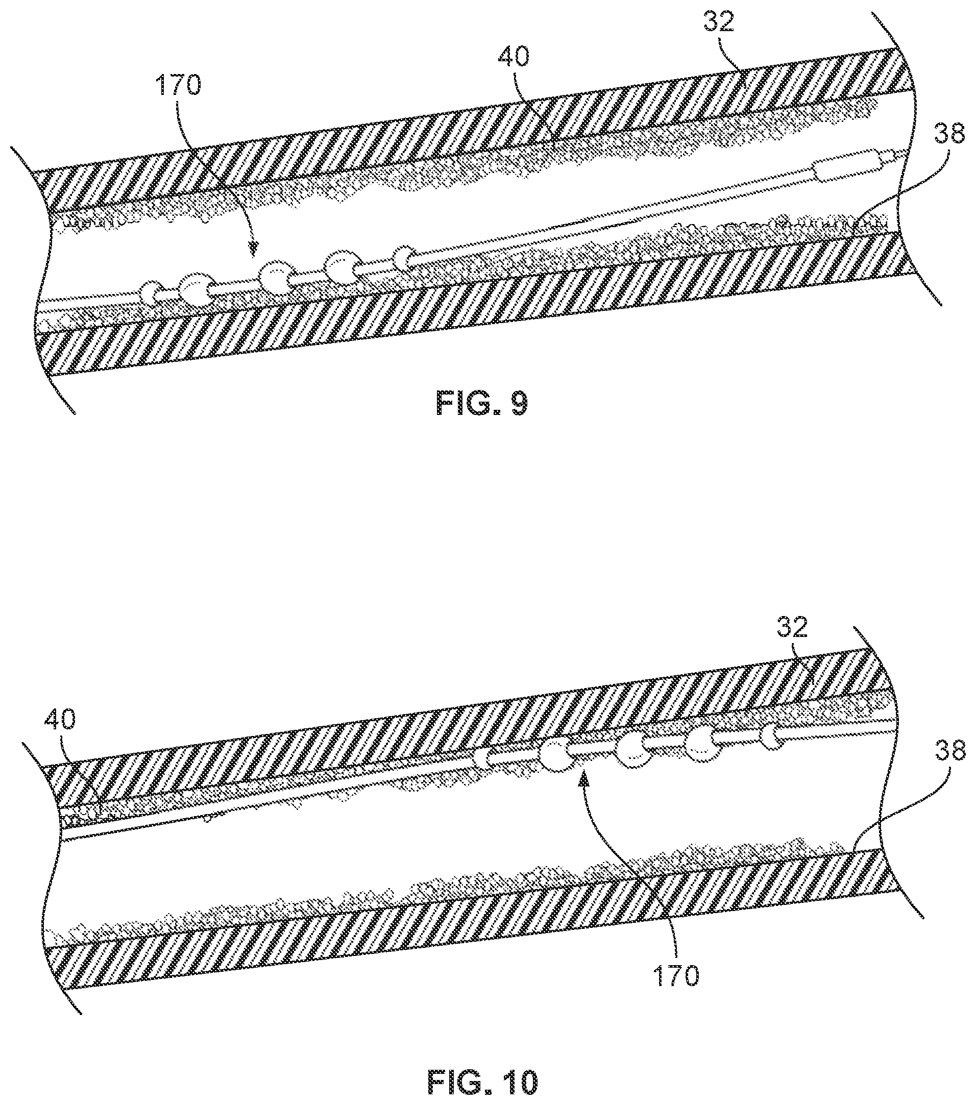Patent US11812988 Figure 6 – Atherectomy devices and methods