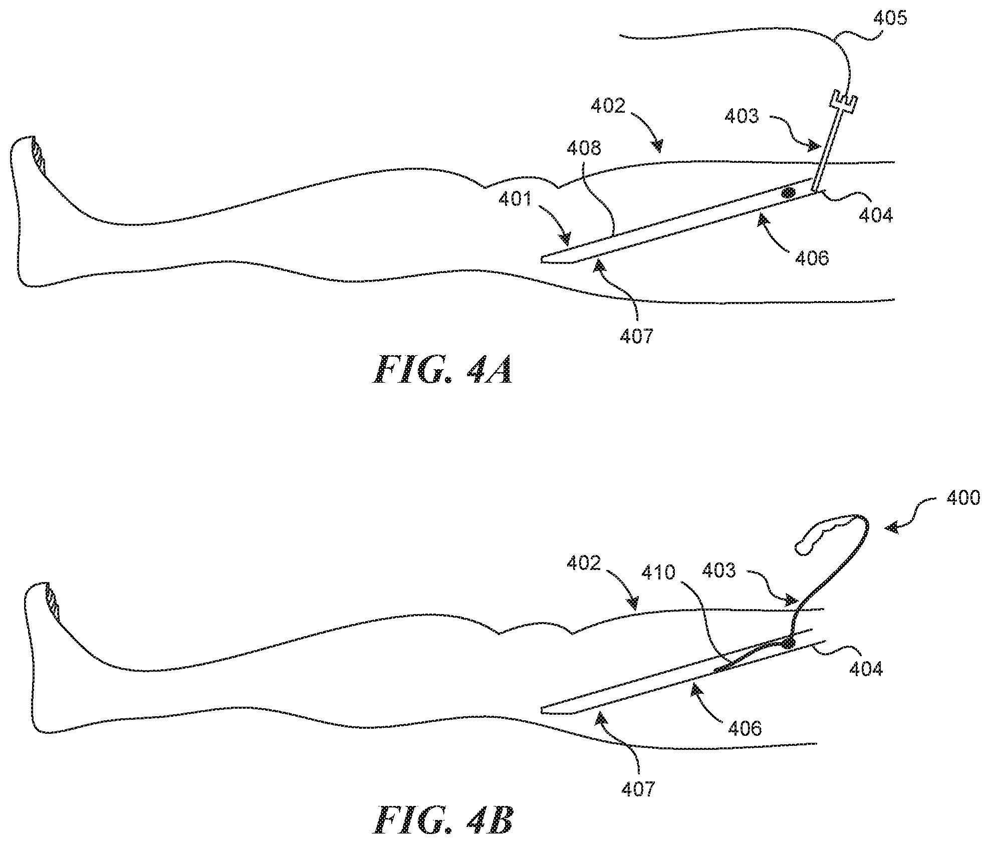 Patent US11812990 Figure 3 – Systems and methods for endoluminal valve creation