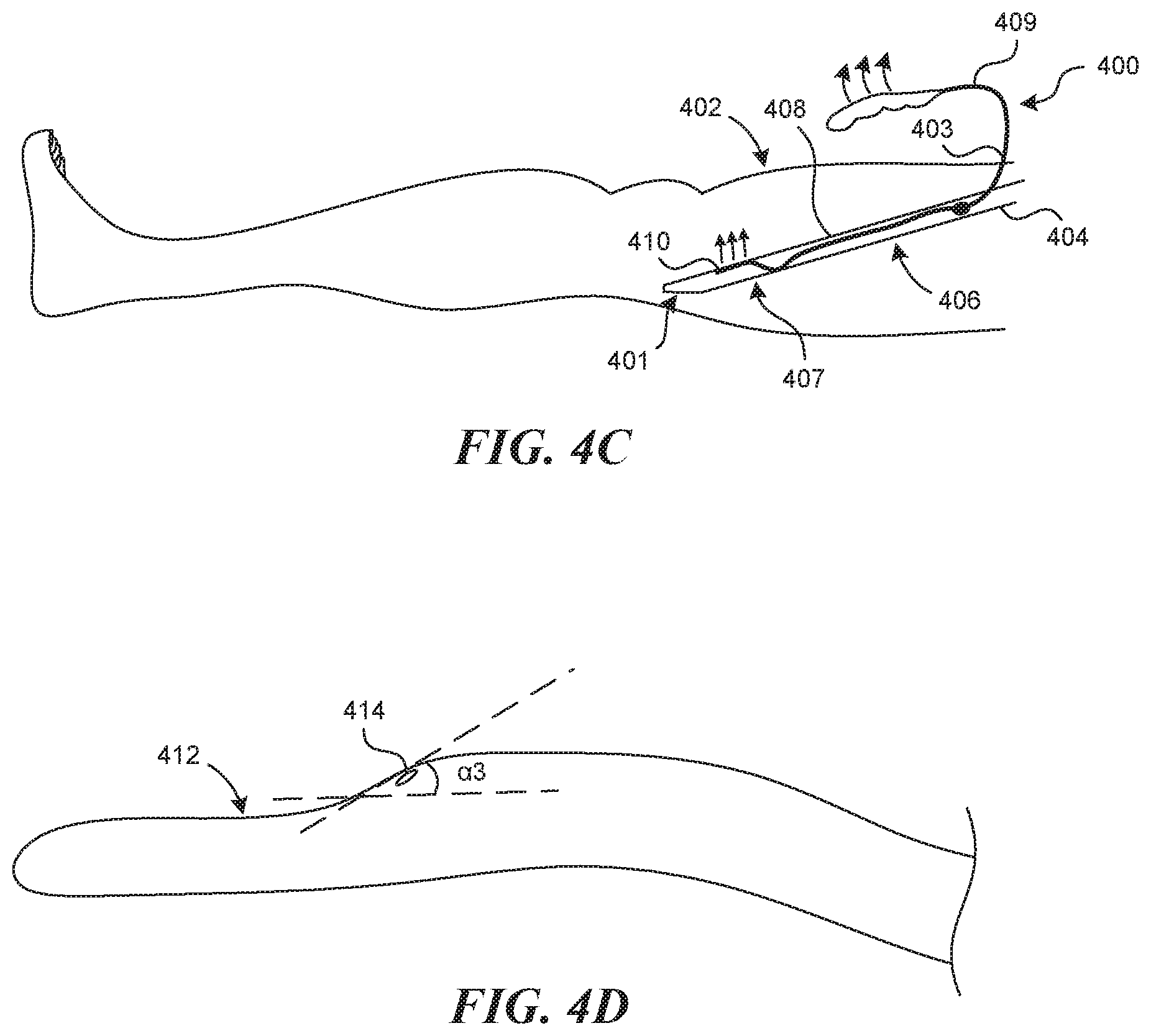 Patent US11812990 Figure 4 – Systems and methods for endoluminal valve creation