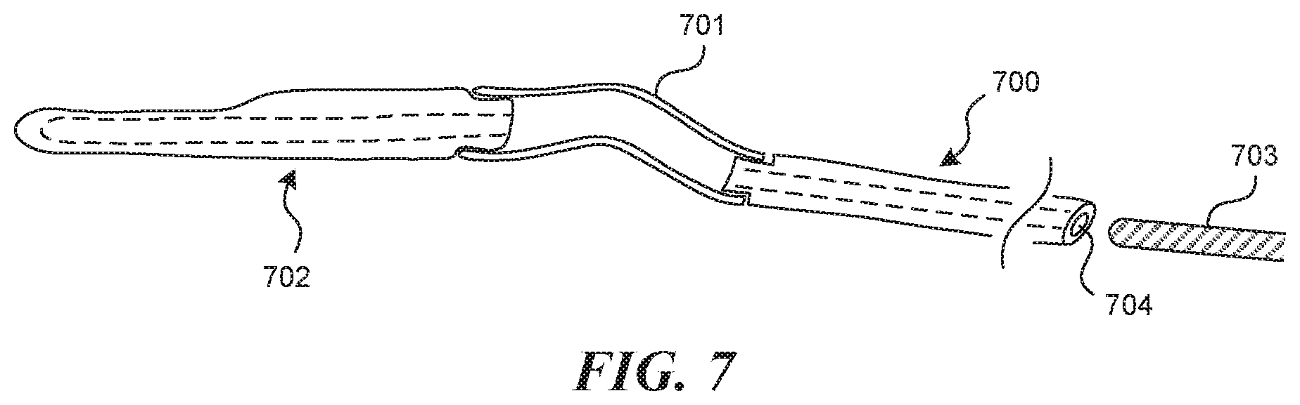 Patent US11812990 Figure 6 – Systems and methods for endoluminal valve creation