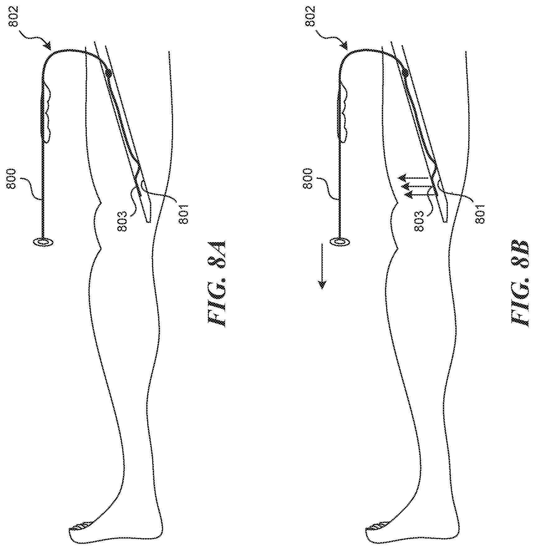 Patent US11812990 Figure 7 – Systems and methods for endoluminal valve creation