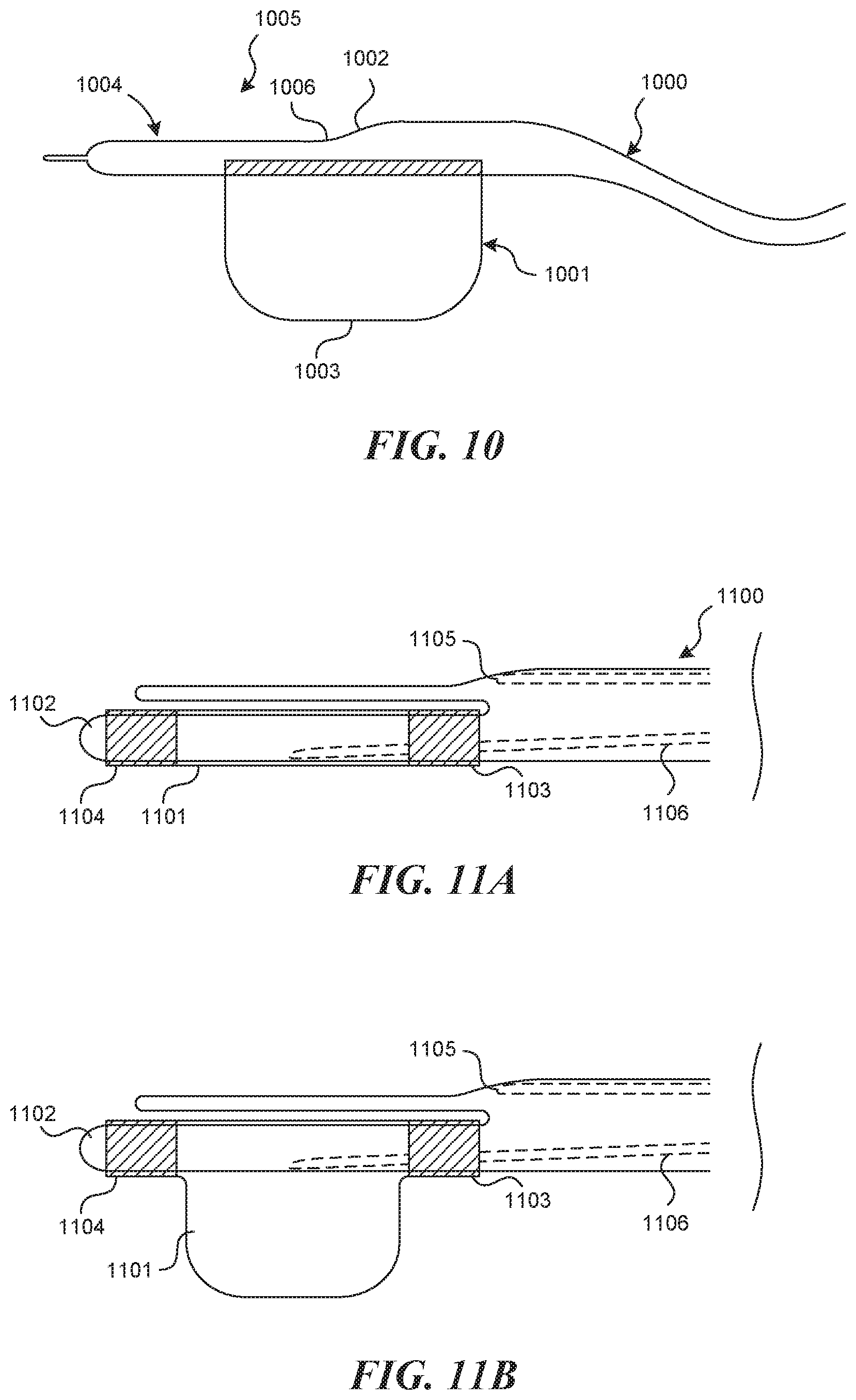 Patent US11812990 Figure 9 – Systems and methods for endoluminal valve creation