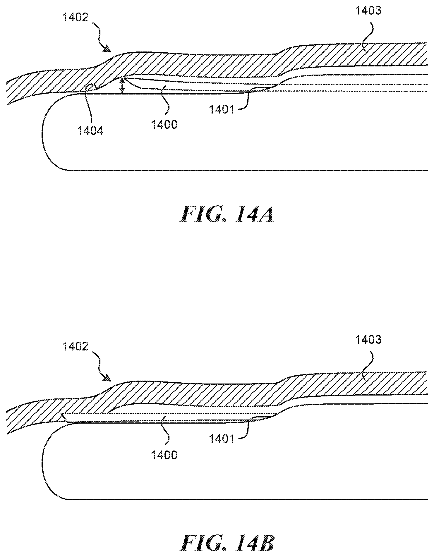 Patent US11812990 Figure 12 – Systems and methods for endoluminal valve creation