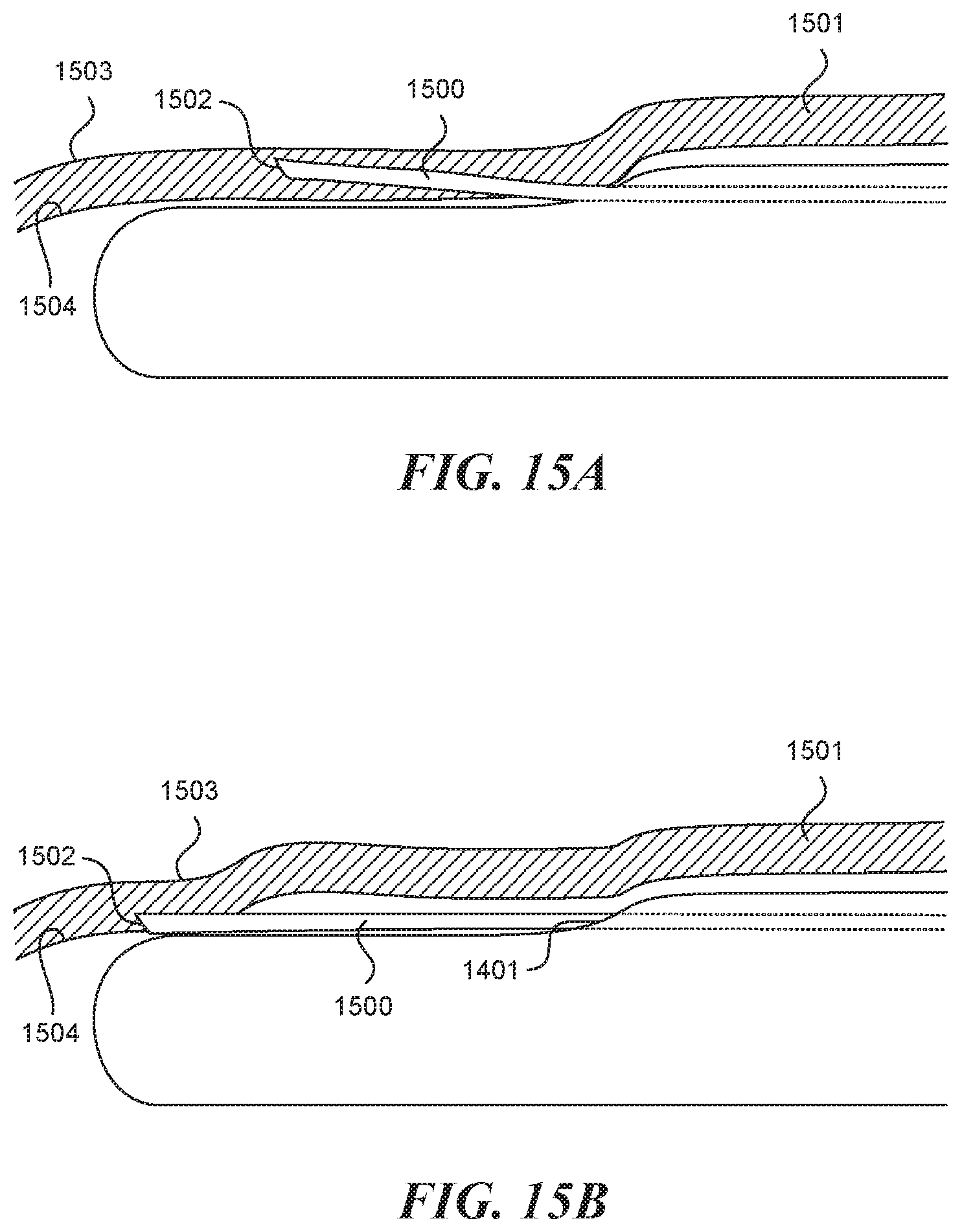 Patent US11812990 Figure 13 – Systems and methods for endoluminal valve creation