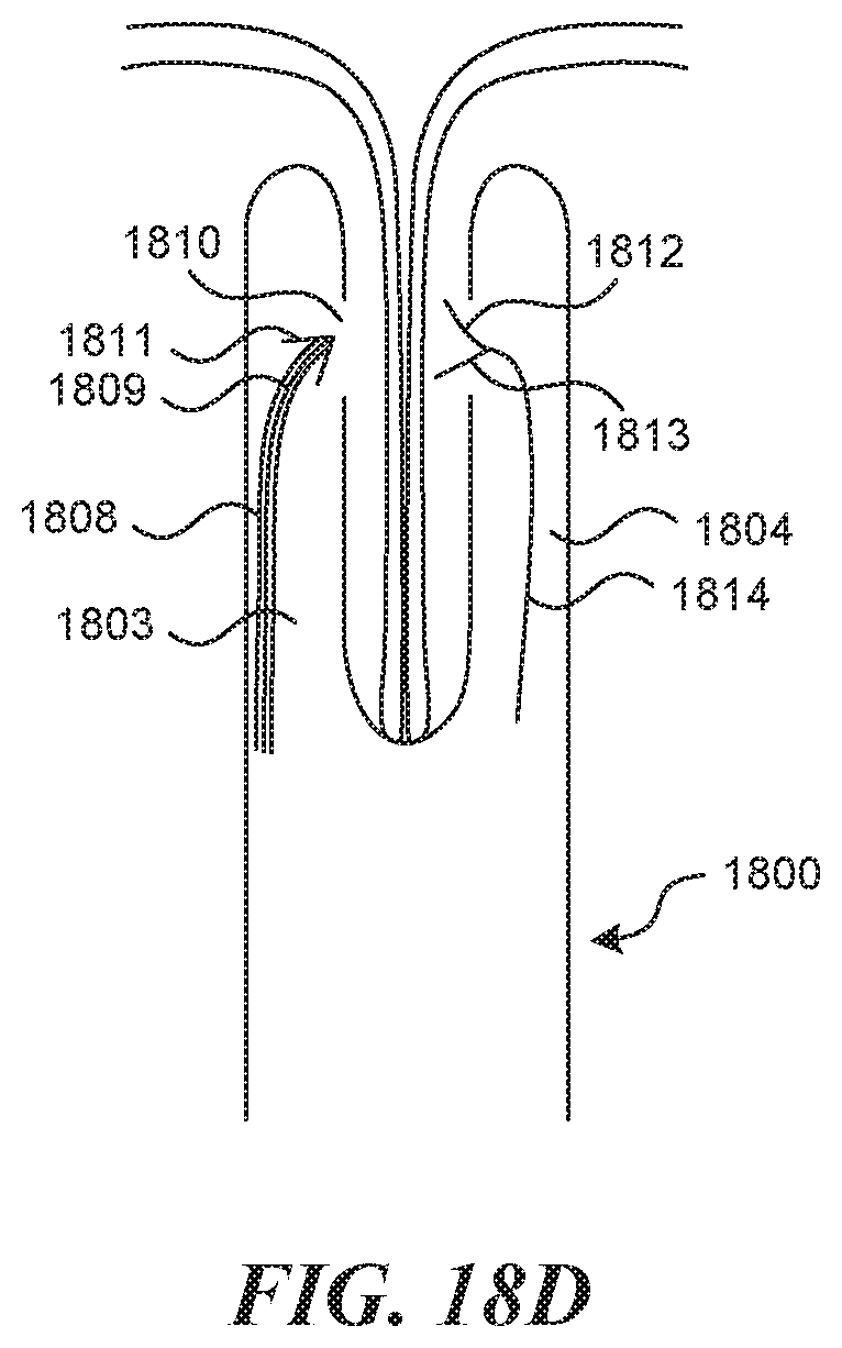Patent US11812990 Figure 18 – Systems and methods for endoluminal valve creation