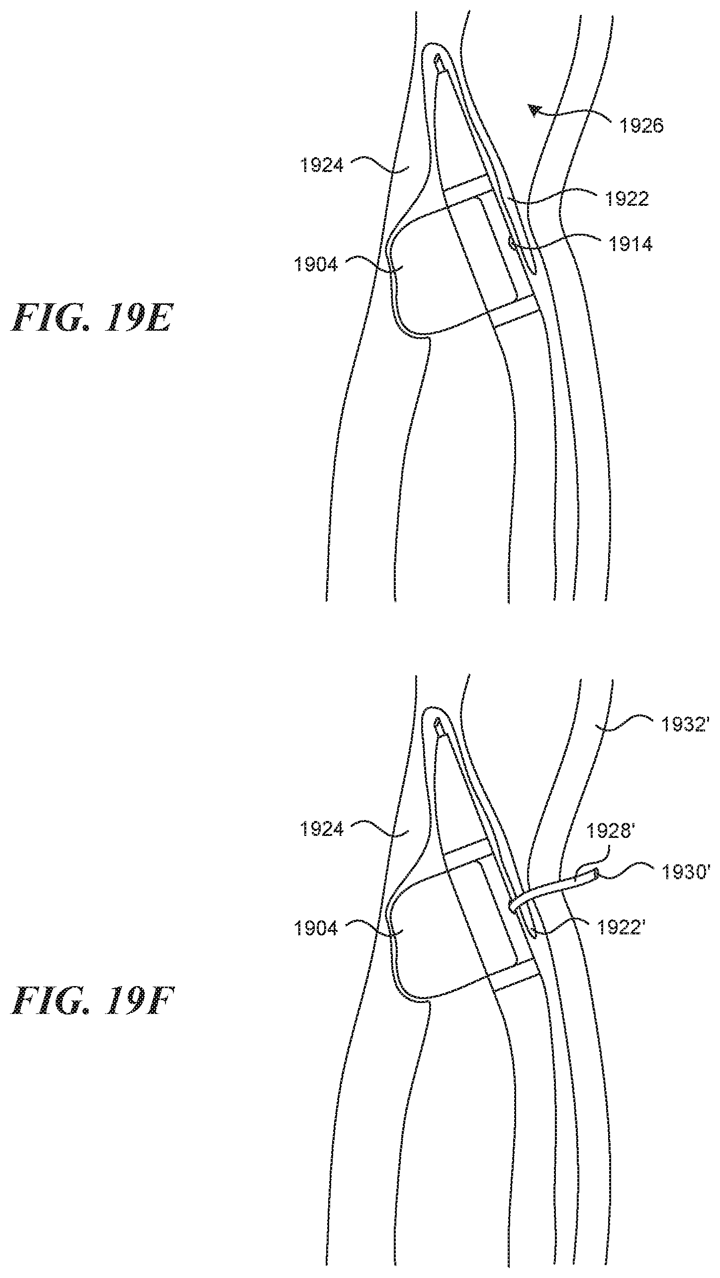 Patent US11812990 Figure 20 – Systems and methods for endoluminal valve creation