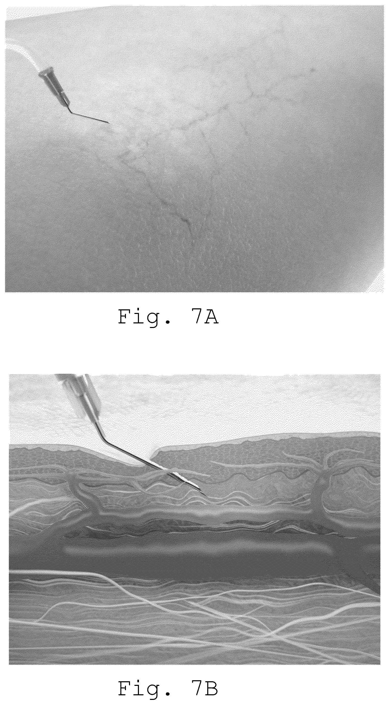 Patent US11812994 Figure 3 – Device and method for the treatment of telangiectasias