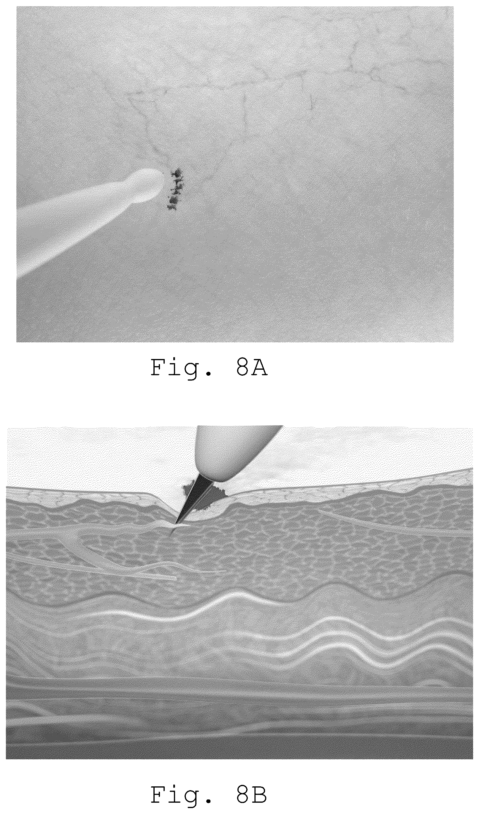 Patent US11812994 Figure 4 – Device and method for the treatment of telangiectasias