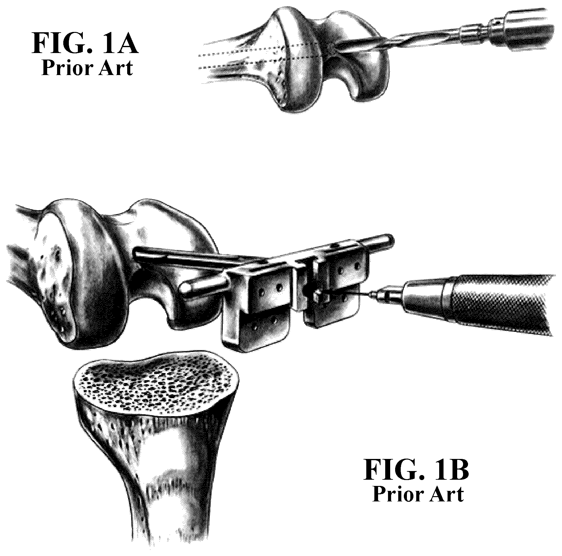 Patent US11812996 Figure 1 – Plug for bone tissue