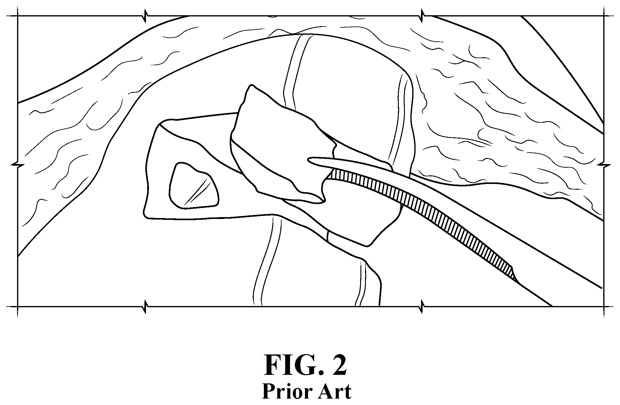Patent US11812996 Figure 2 – Plug for bone tissue