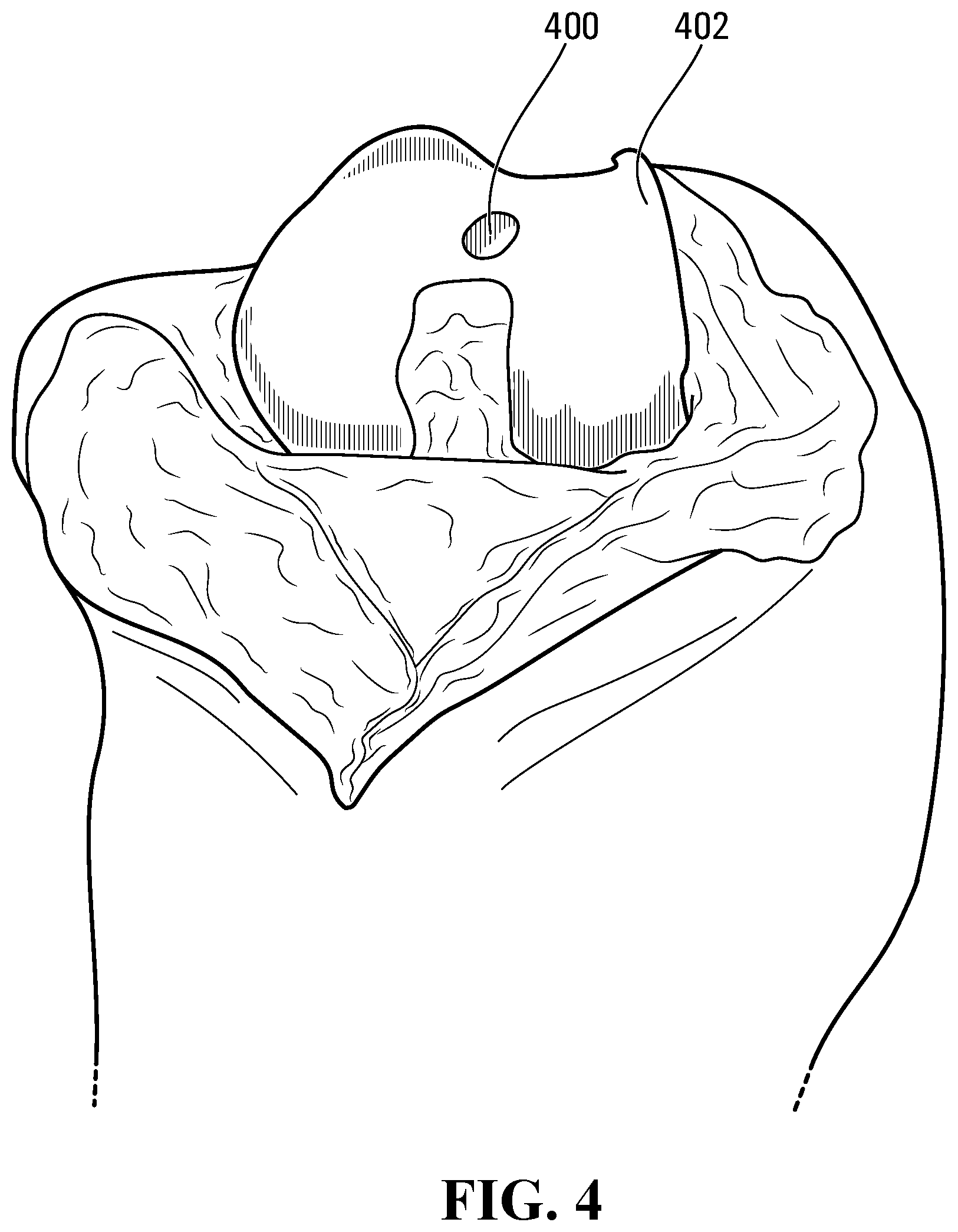 Patent US11812996 Figure 4 – Plug for bone tissue