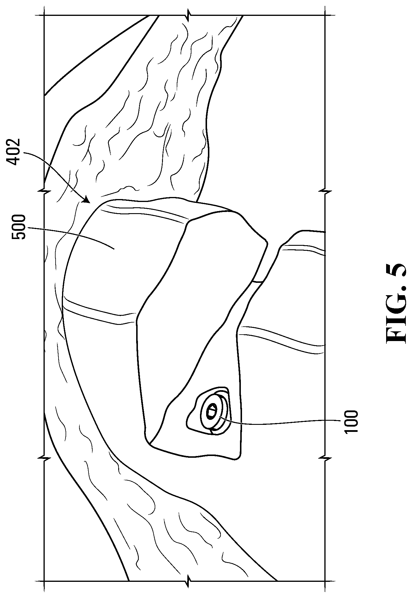 Patent US11812996 Figure 5 – Plug for bone tissue