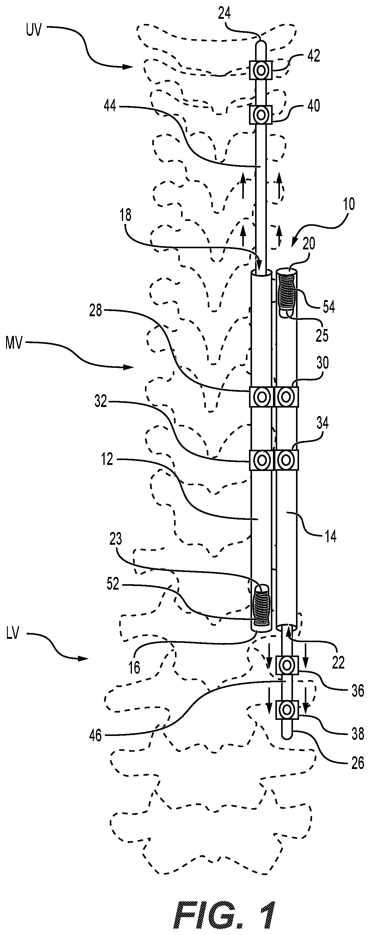 Patent US11812997 Figure 1 – System and method for treating early onset scoliosis