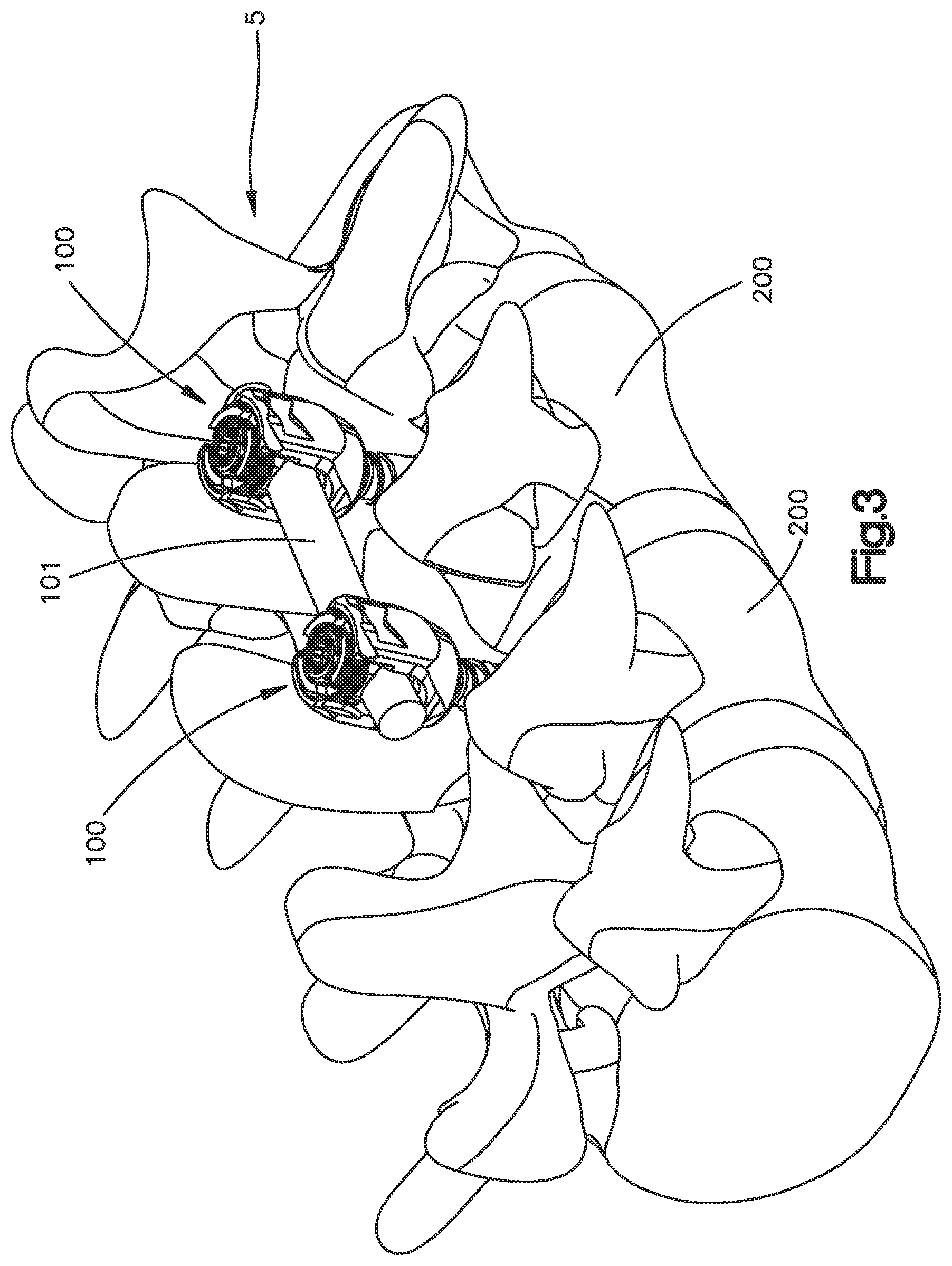 Patent US11812998 Figure 3 – Bone fixation assembly