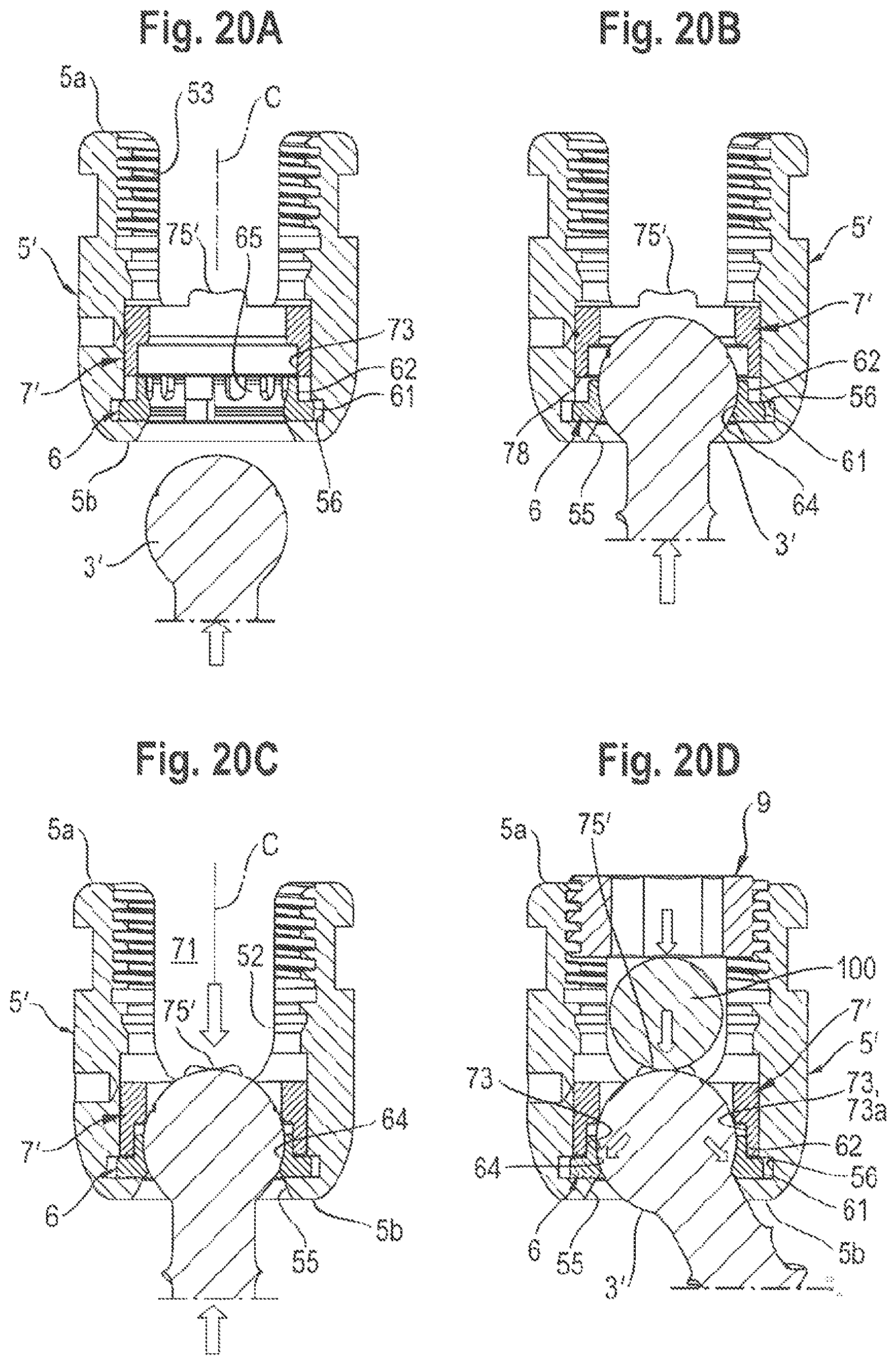 Patent US11812999 Figure 12 – Coupling assembly and polyaxial bone anchoring device comprising the same