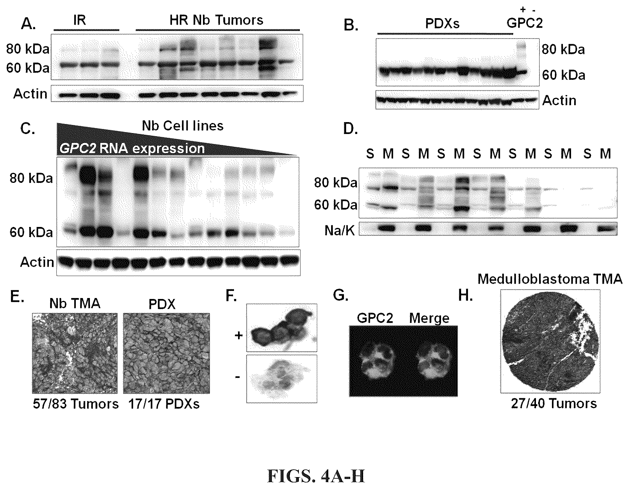 Patent US11814440 Figure 4 – Glypican 2 as a cancer marker and therapeutic target