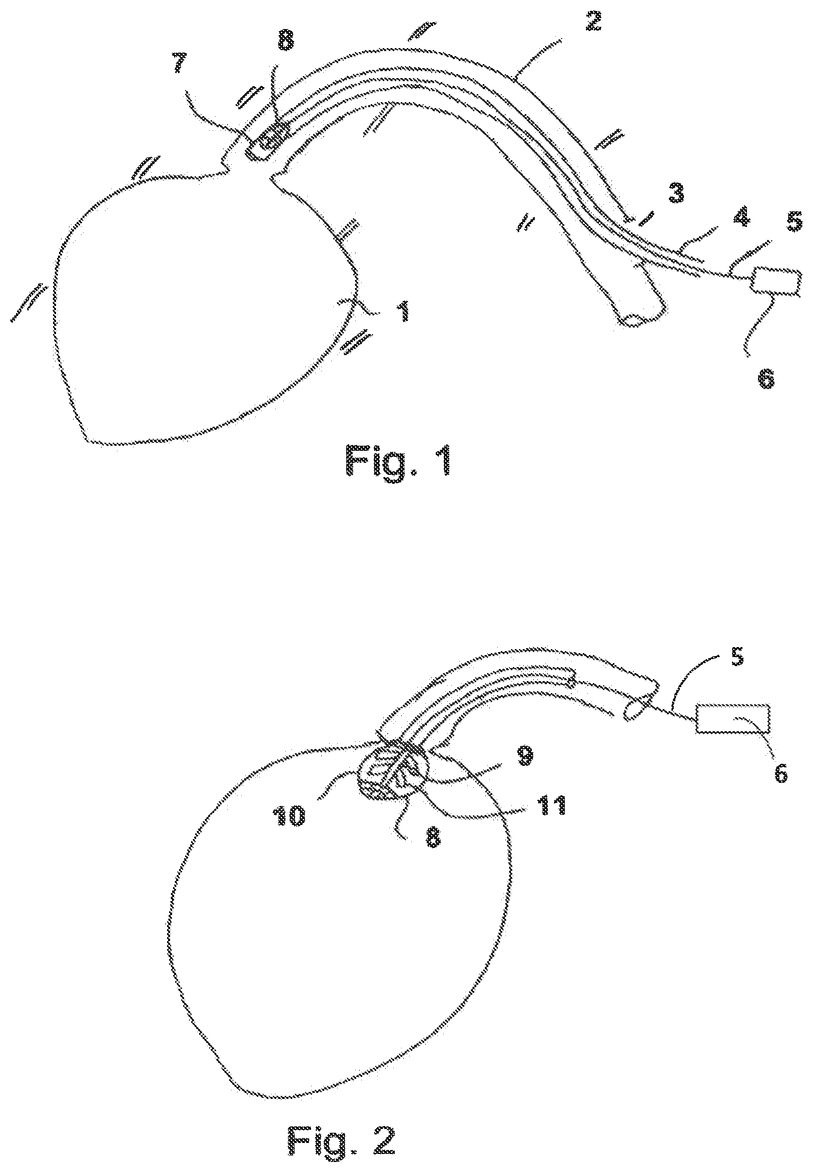 Patent US11815097 Figure 1 – Pump device having a detection device