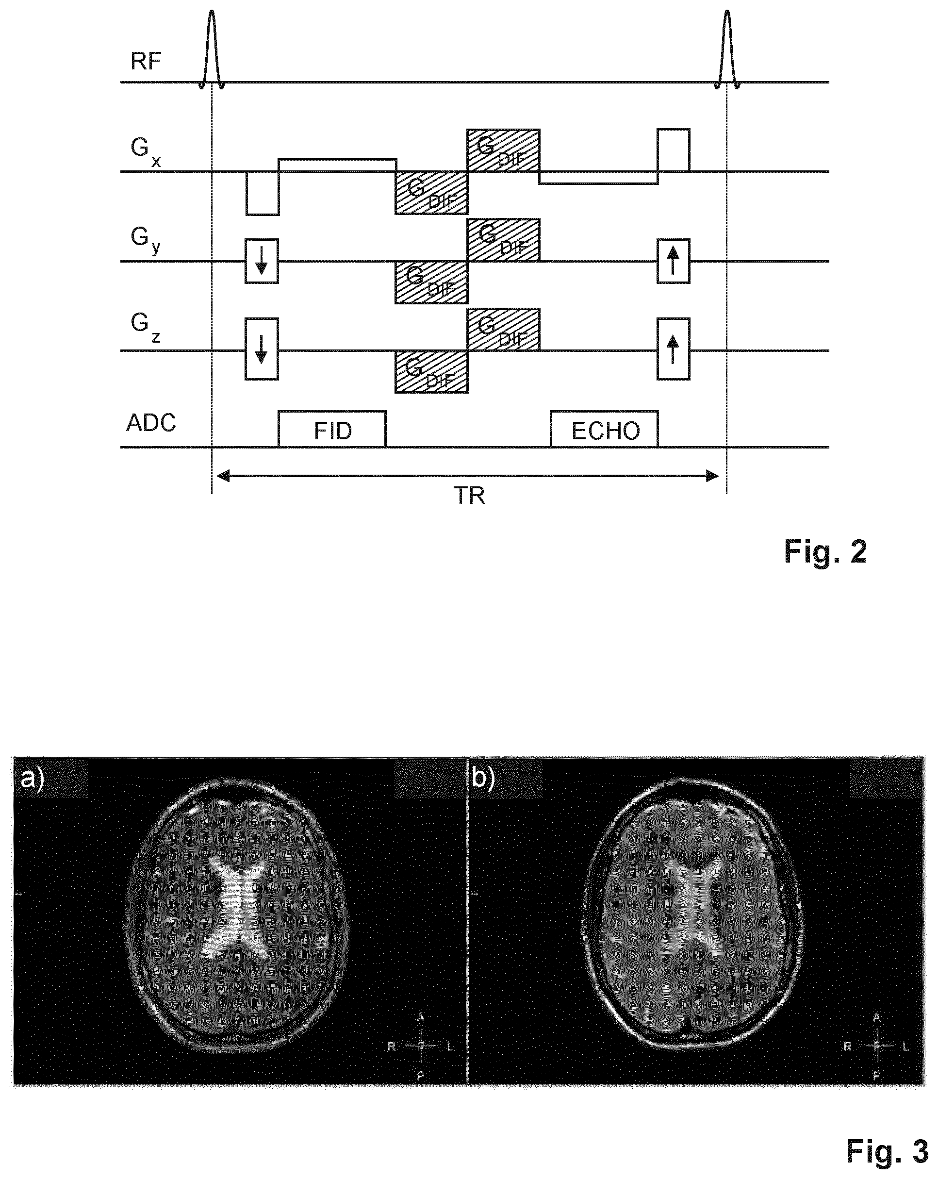 Patent US11815582 Figure 2 – Dual echo steady state MR imaging using bipolar diffusion gradients
