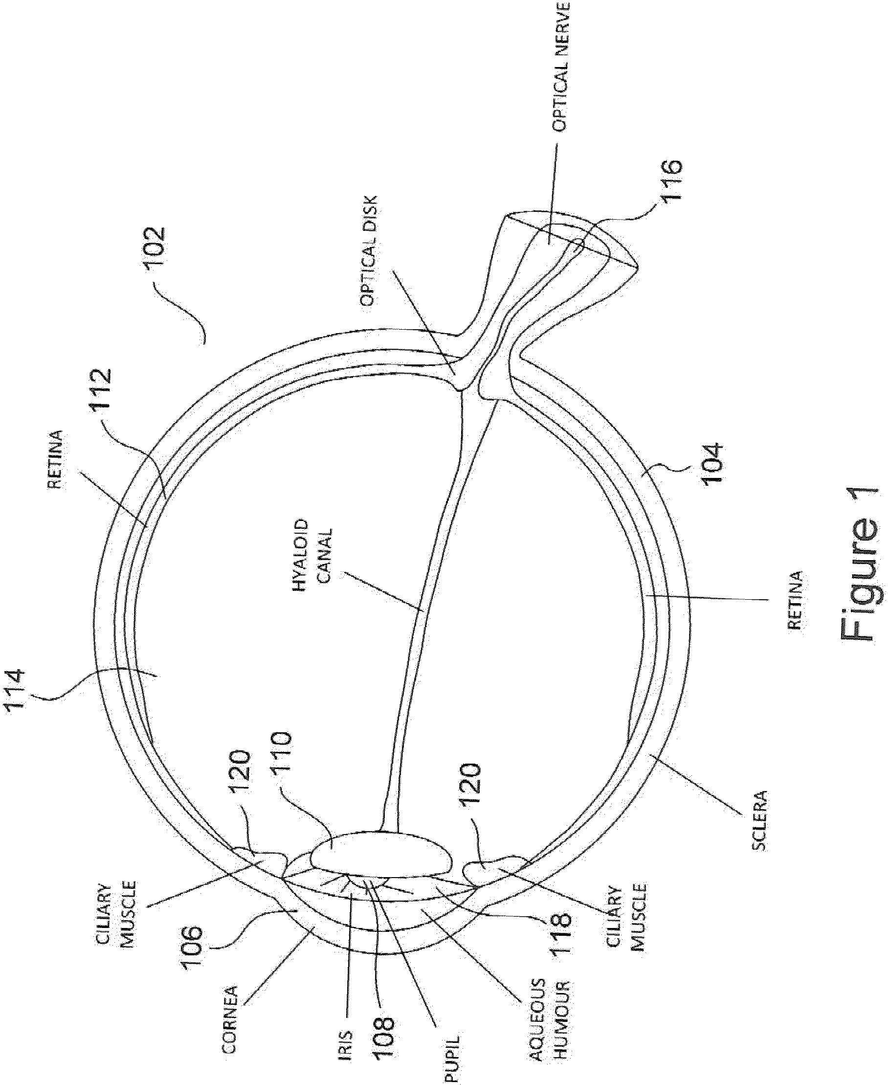 Patent US11815745 Figure 1 – Method and apparatus for limiting growth of eye length