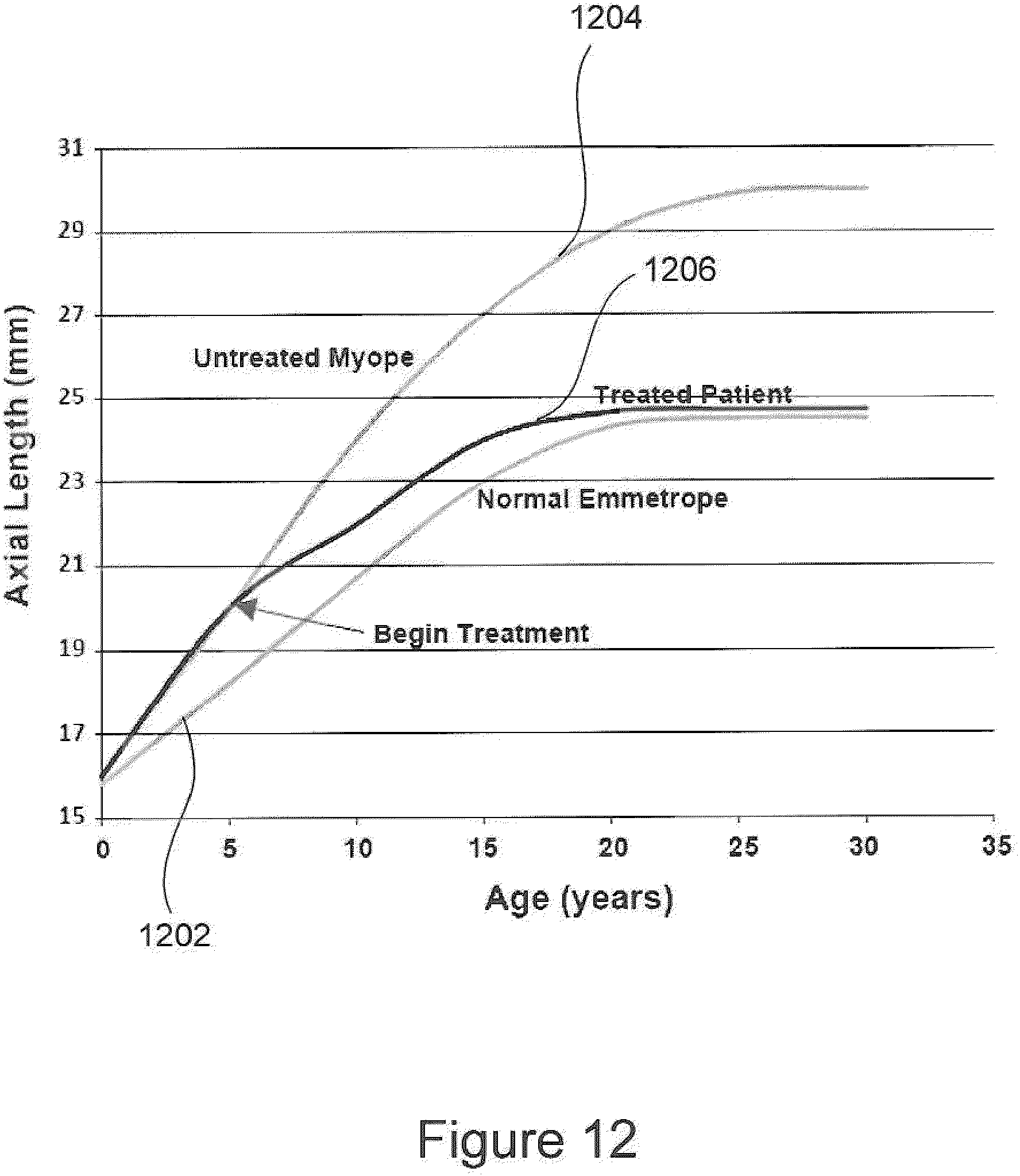 Patent US11815745 Figure 15 – Method and apparatus for limiting growth of eye length