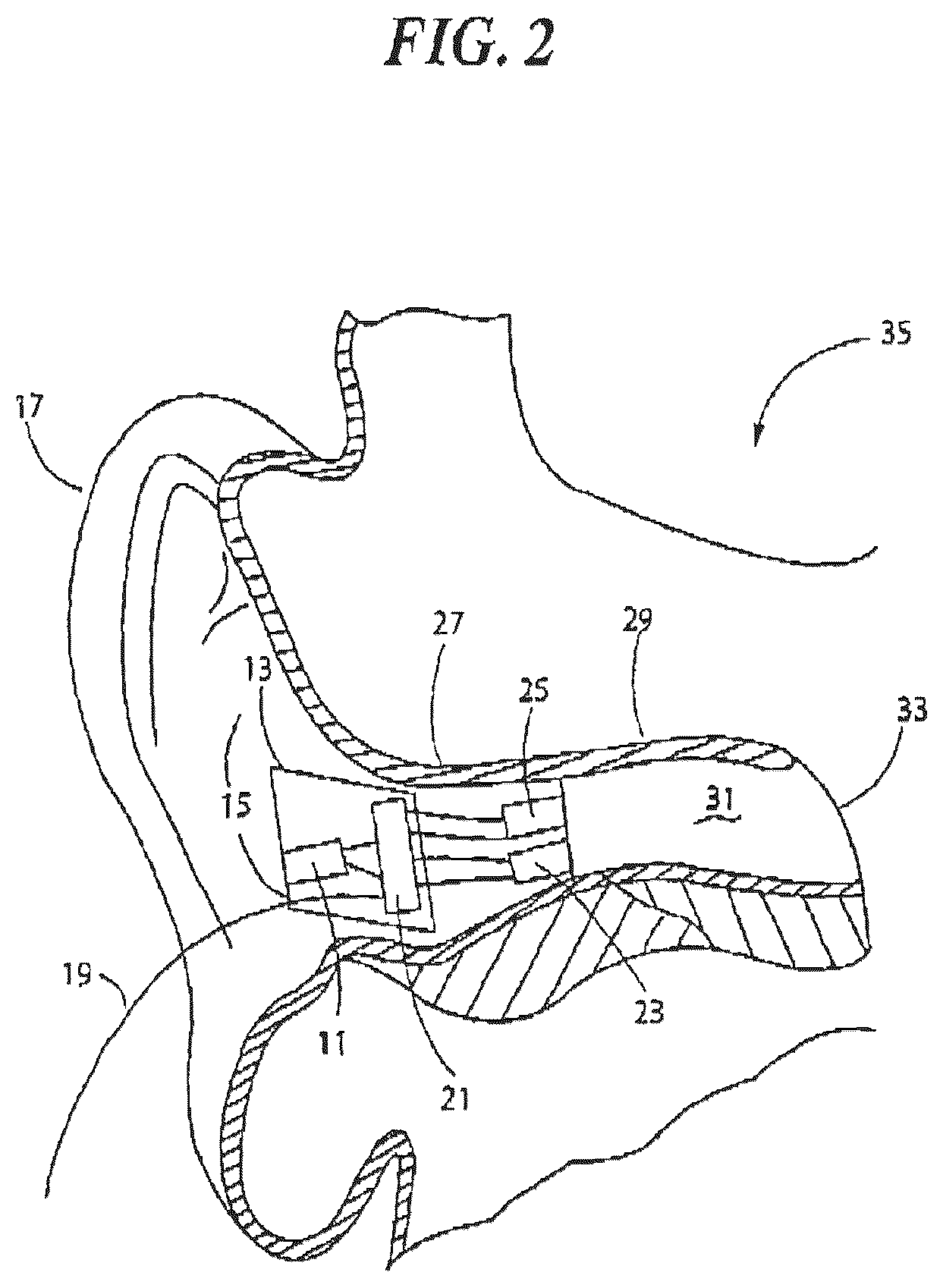 Patent US11818552 Figure 2 – Earguard monitoring system