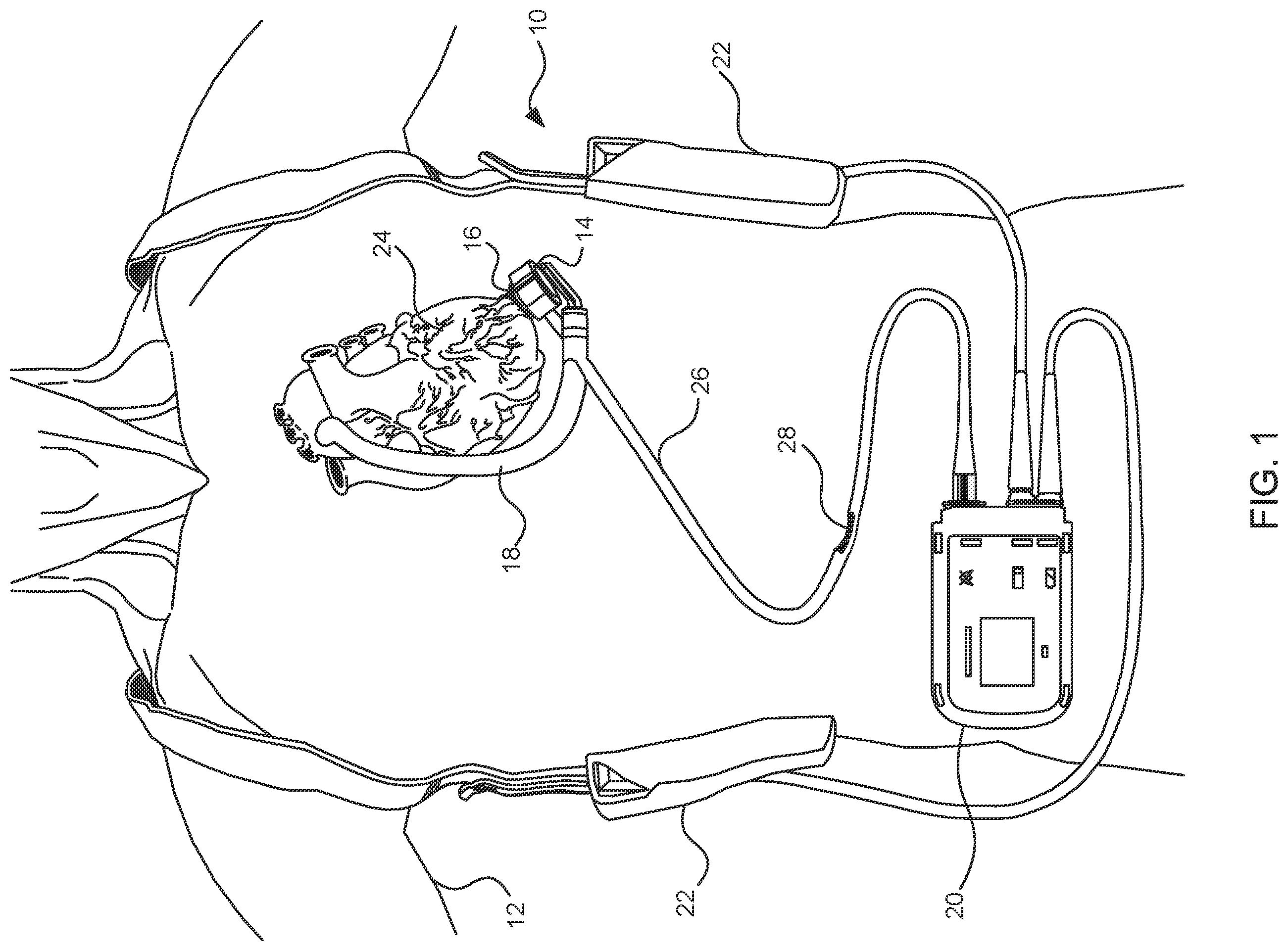 Patent US11824381 Figure 1 – Blood pump controllers having daisy-chained batteries