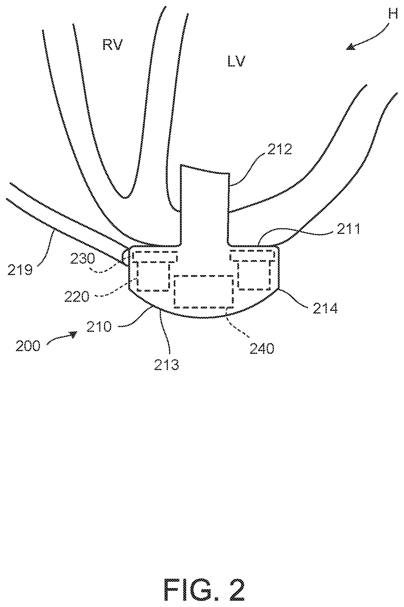 Patent US11824381 Figure 2 – Blood pump controllers having daisy-chained batteries