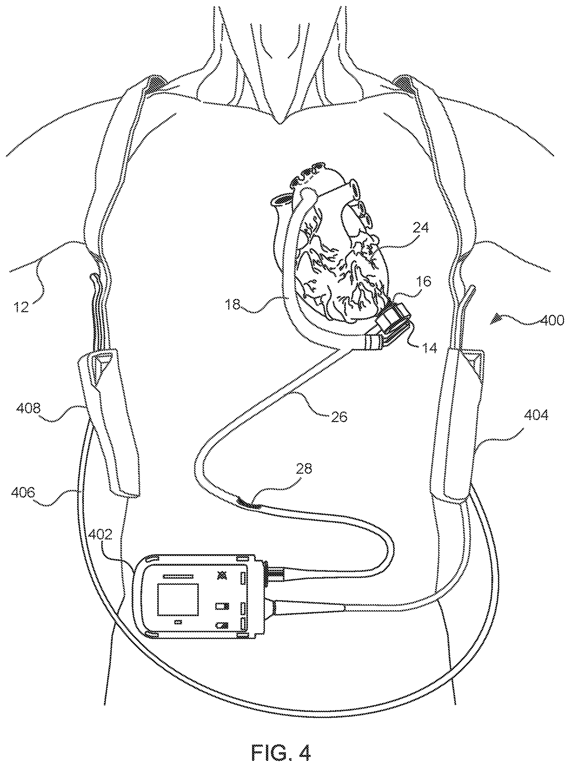 Patent US11824381 Figure 4 – Blood pump controllers having daisy-chained batteries