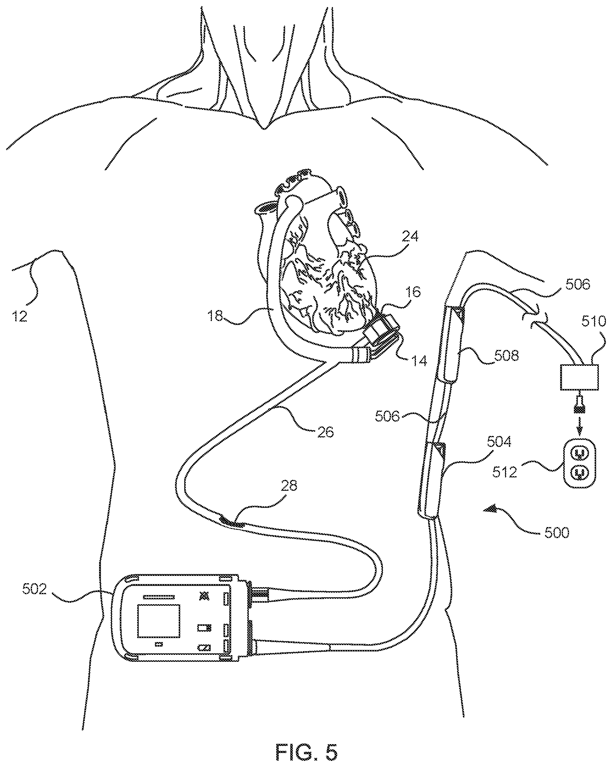 Patent US11824381 Figure 5 – Blood pump controllers having daisy-chained batteries