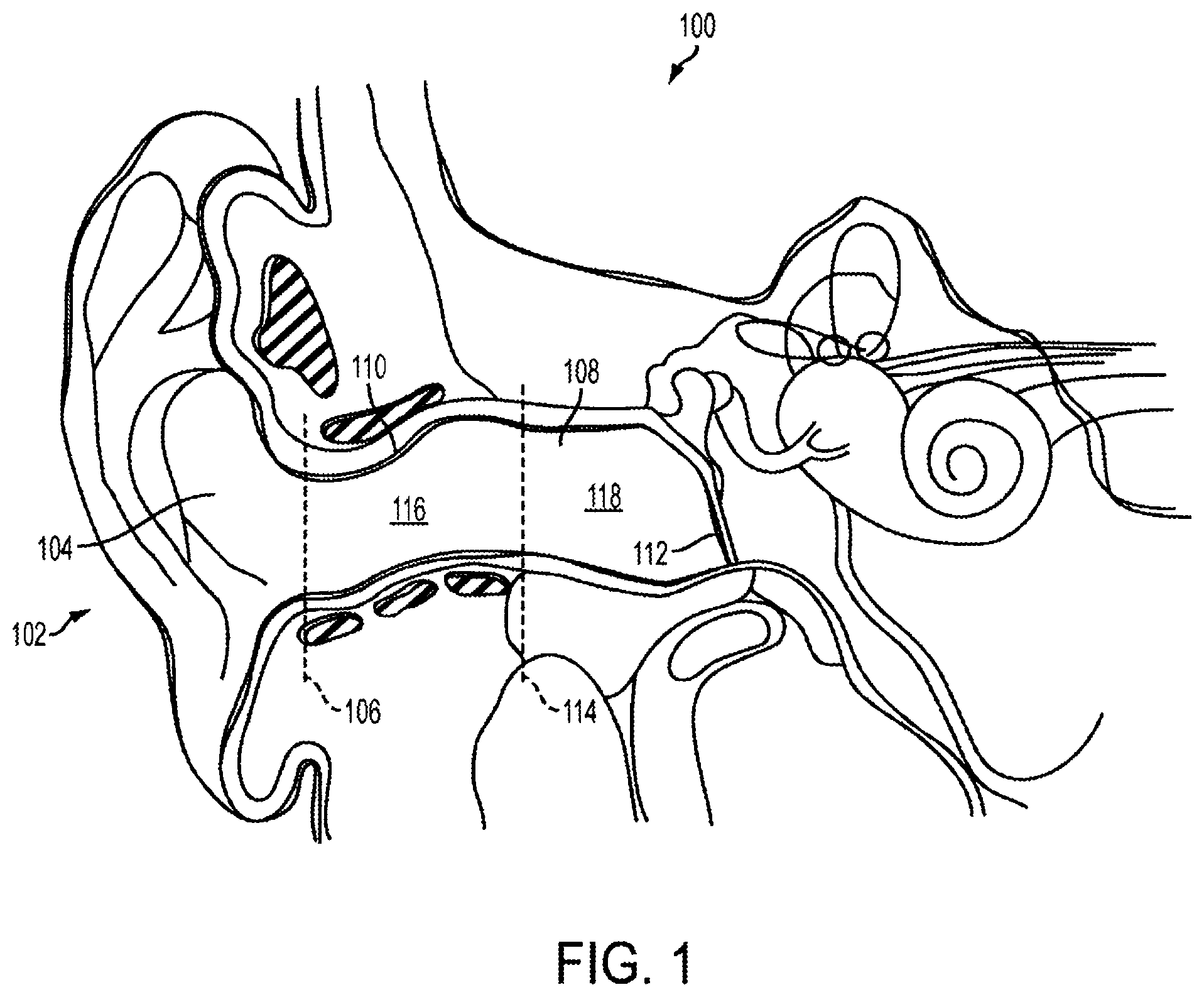 Patent US11832046 Figure 1 – Methods and devices for occluding an ear canal having a predetermined filter characteristic